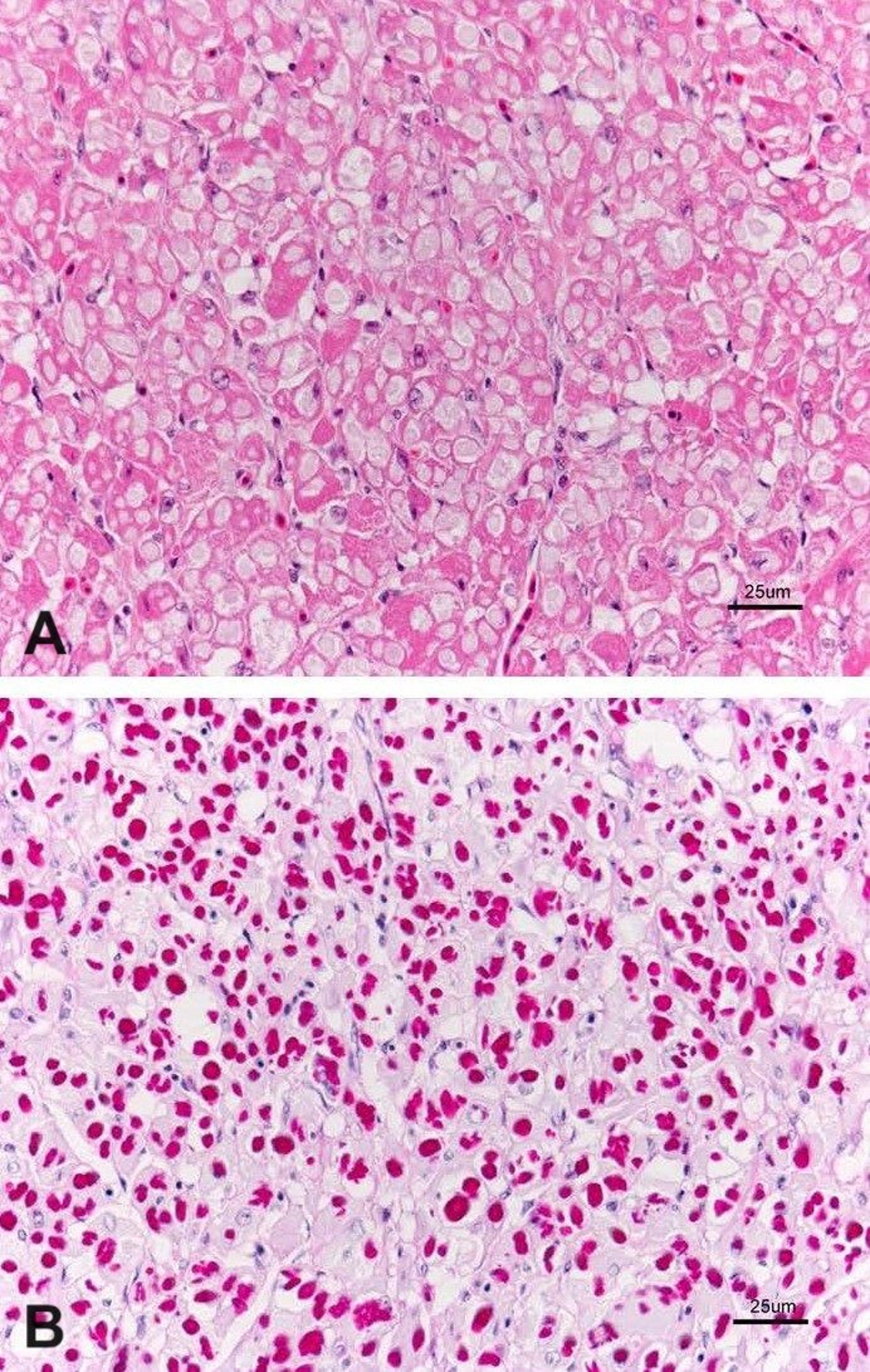 Glycogen storage disease, photomicrograph, quail