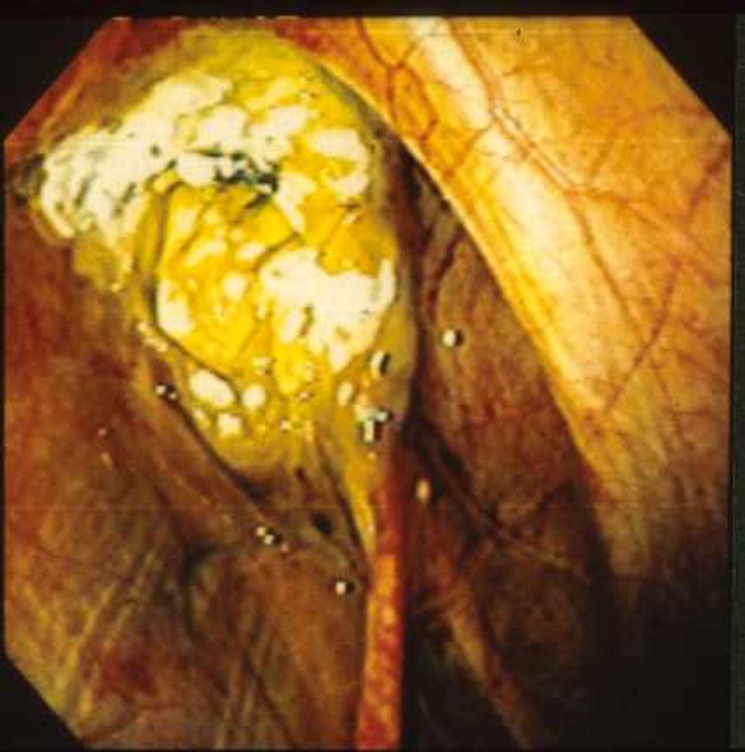 Guttural pouch mycosis (<i >Aspergillus</i>)