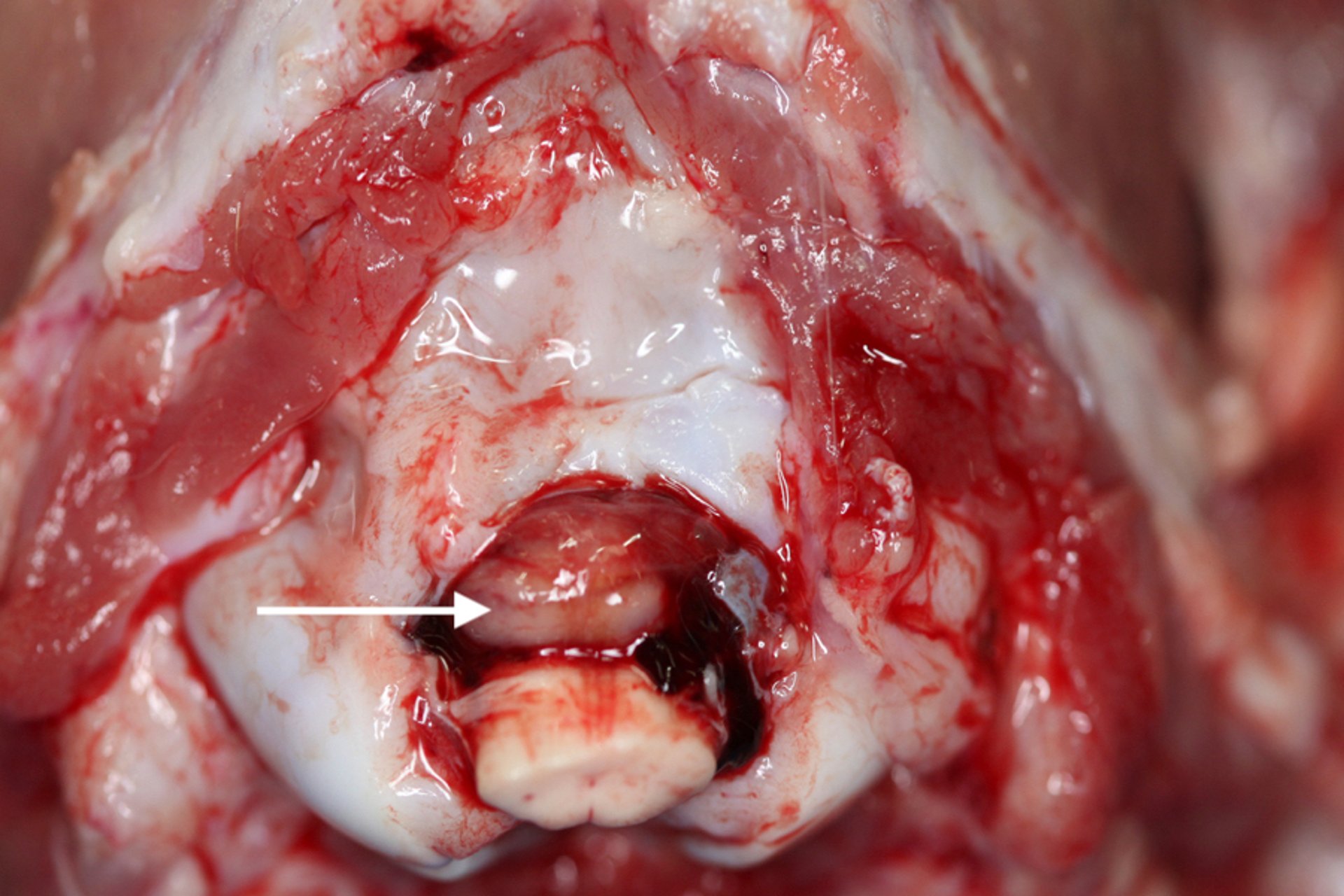 Herniation of the cerebellum