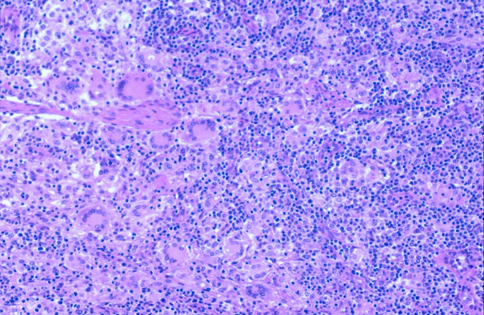 Histopathology of a PCV-2-SD-affected pig