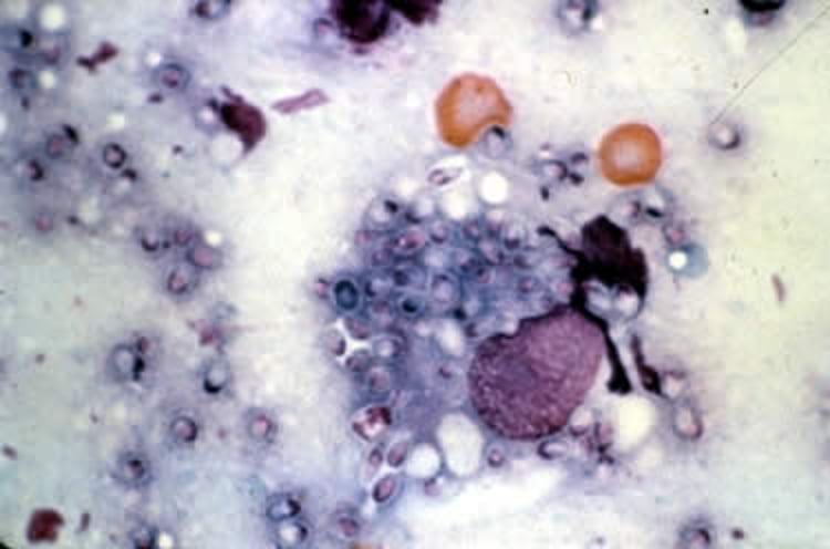 <i >Histoplasma capsulatum</i>, lymph node smear