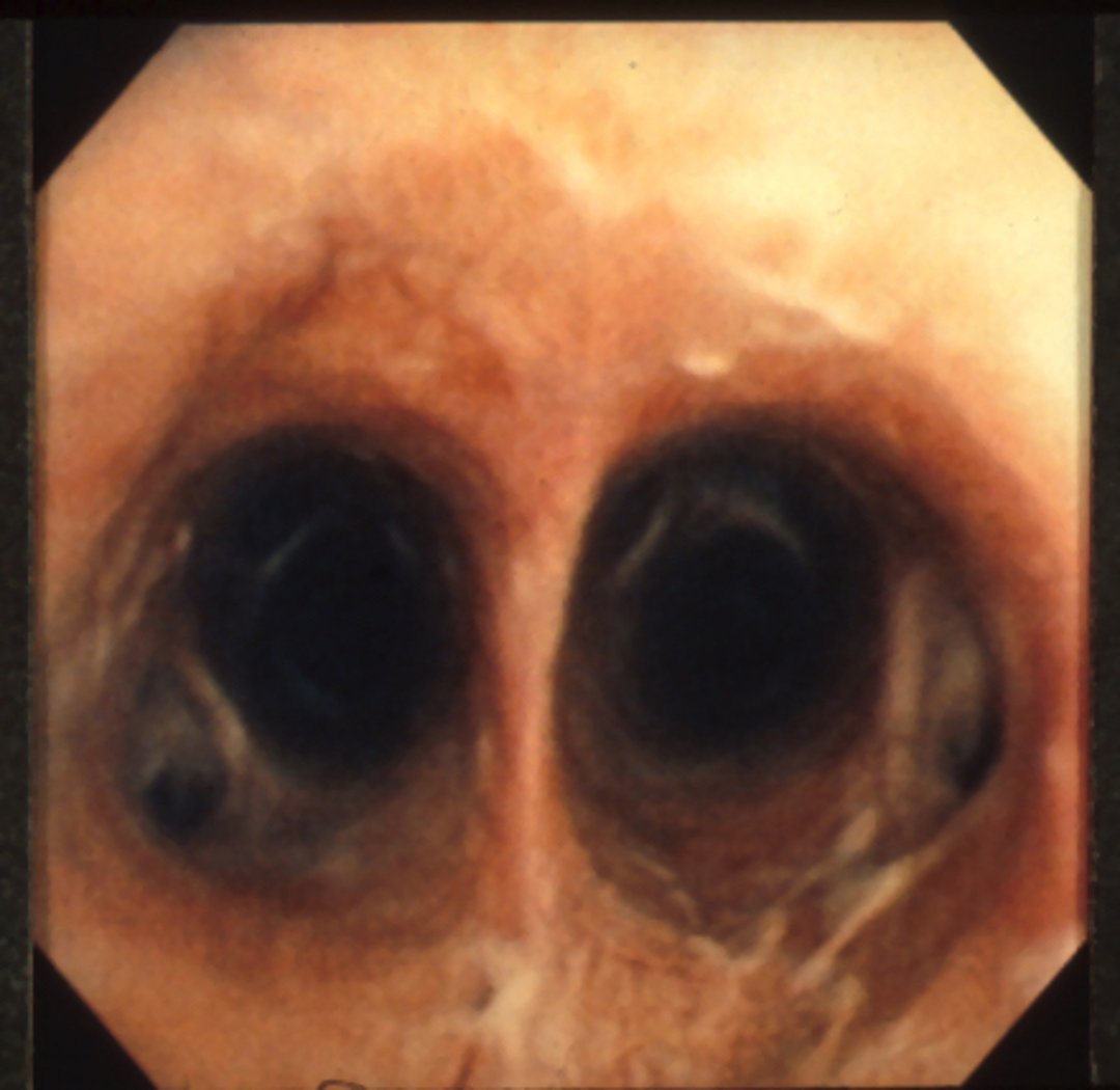 Obstrucción recurrente de las vías respiratorias (RAO)
