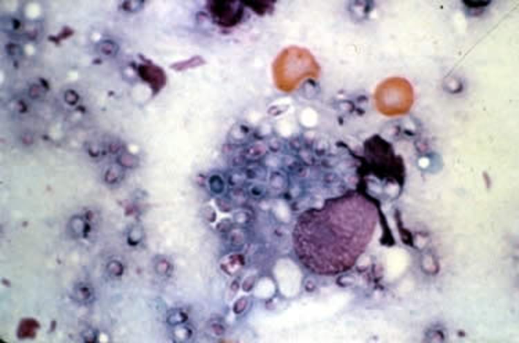 <i >Histoplasma capsulatum</i>, frotis de nódulos linfáticos
