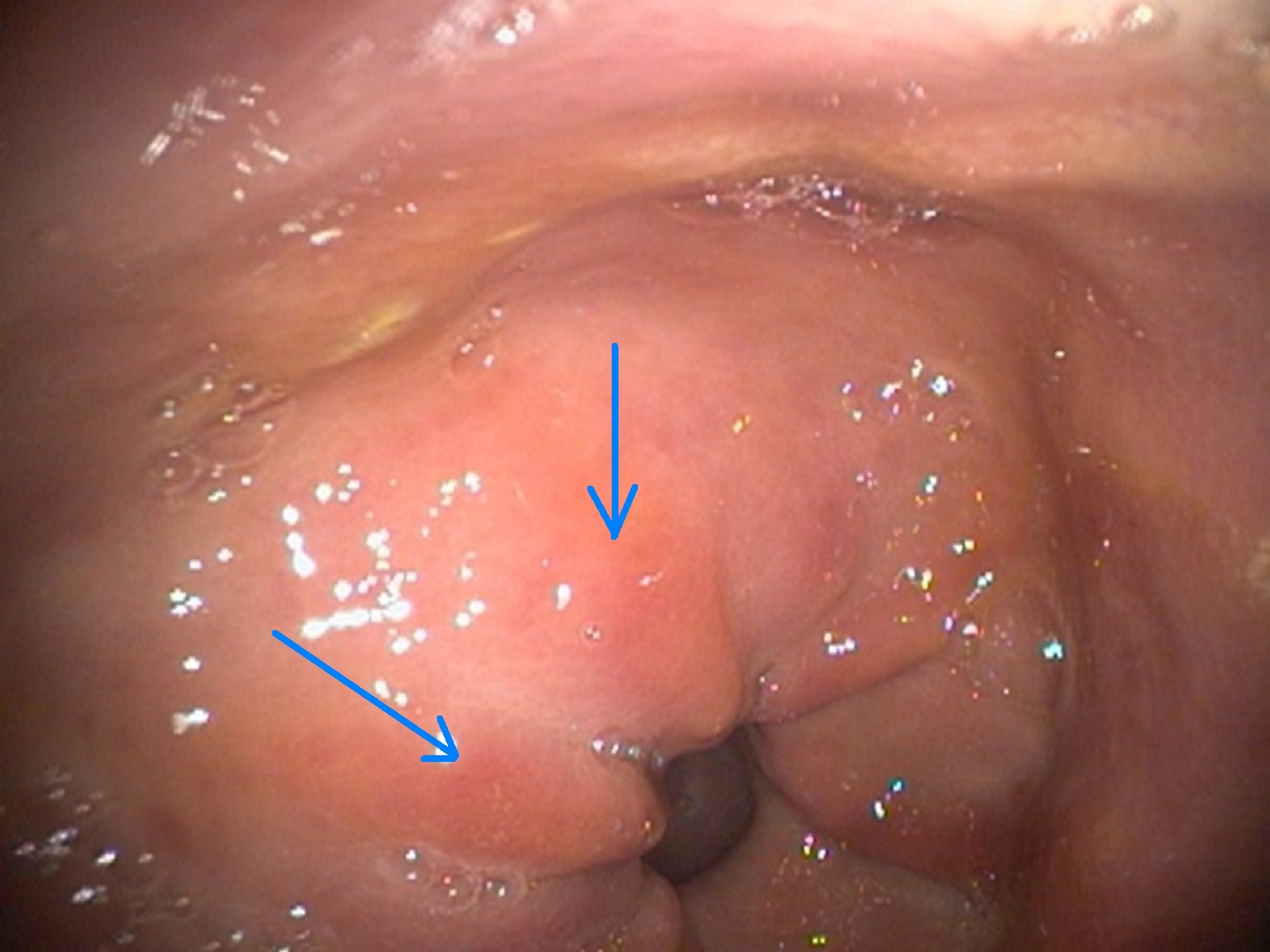 Hiperemia, mucosa glandular, caballo adulto