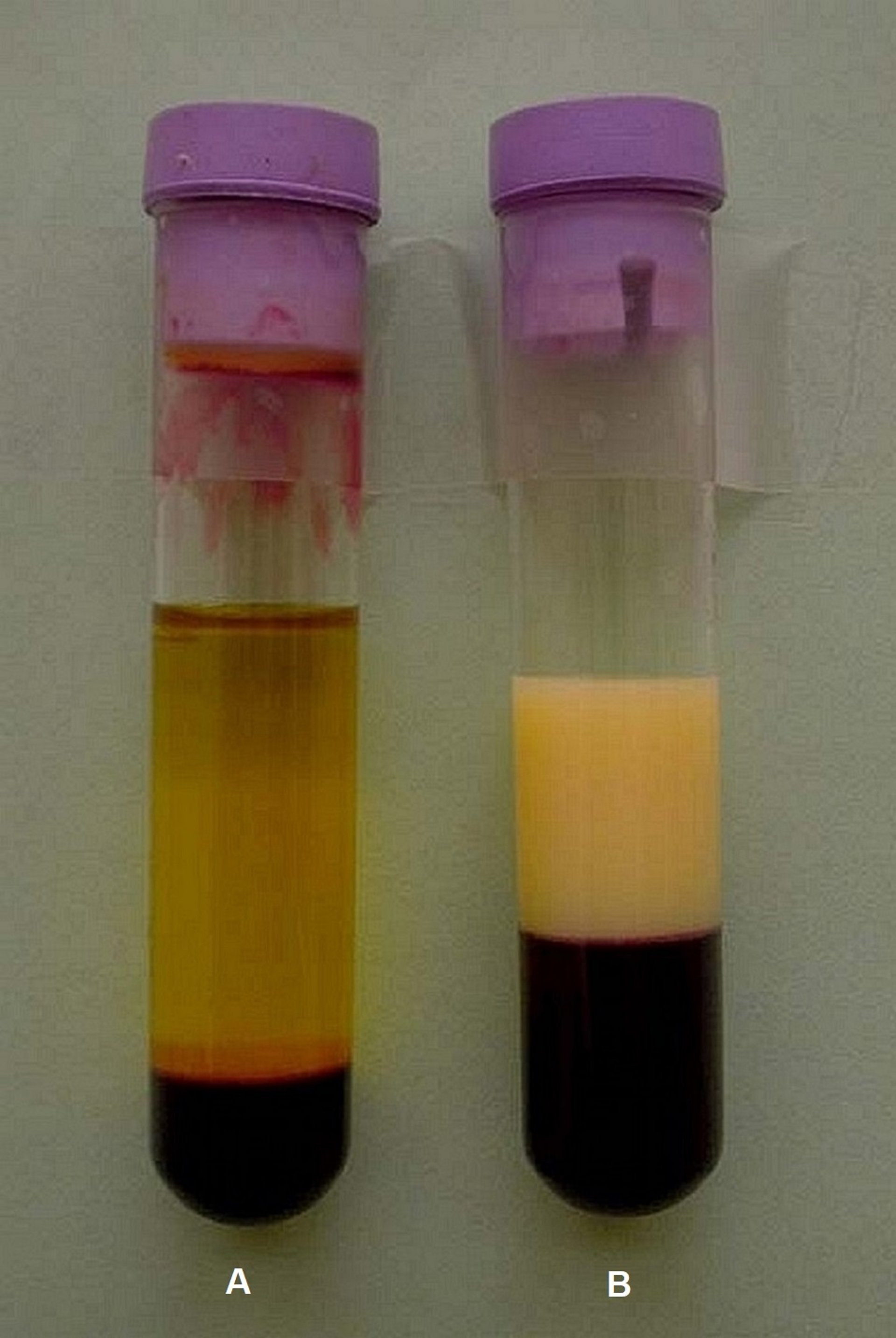 Hiperlipemia, muestra de sangre