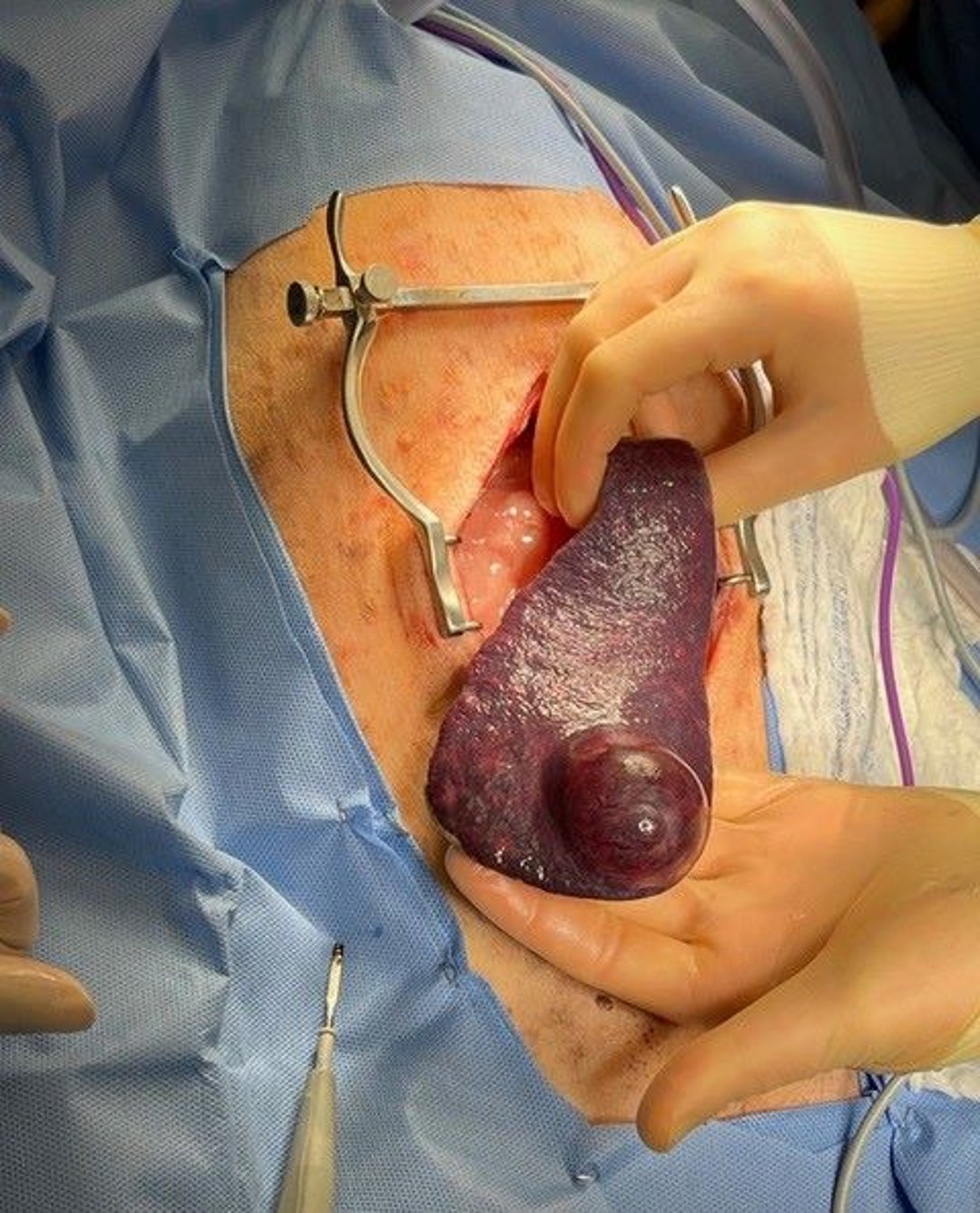 Hipoglicemia, tumor esplênico, cão
