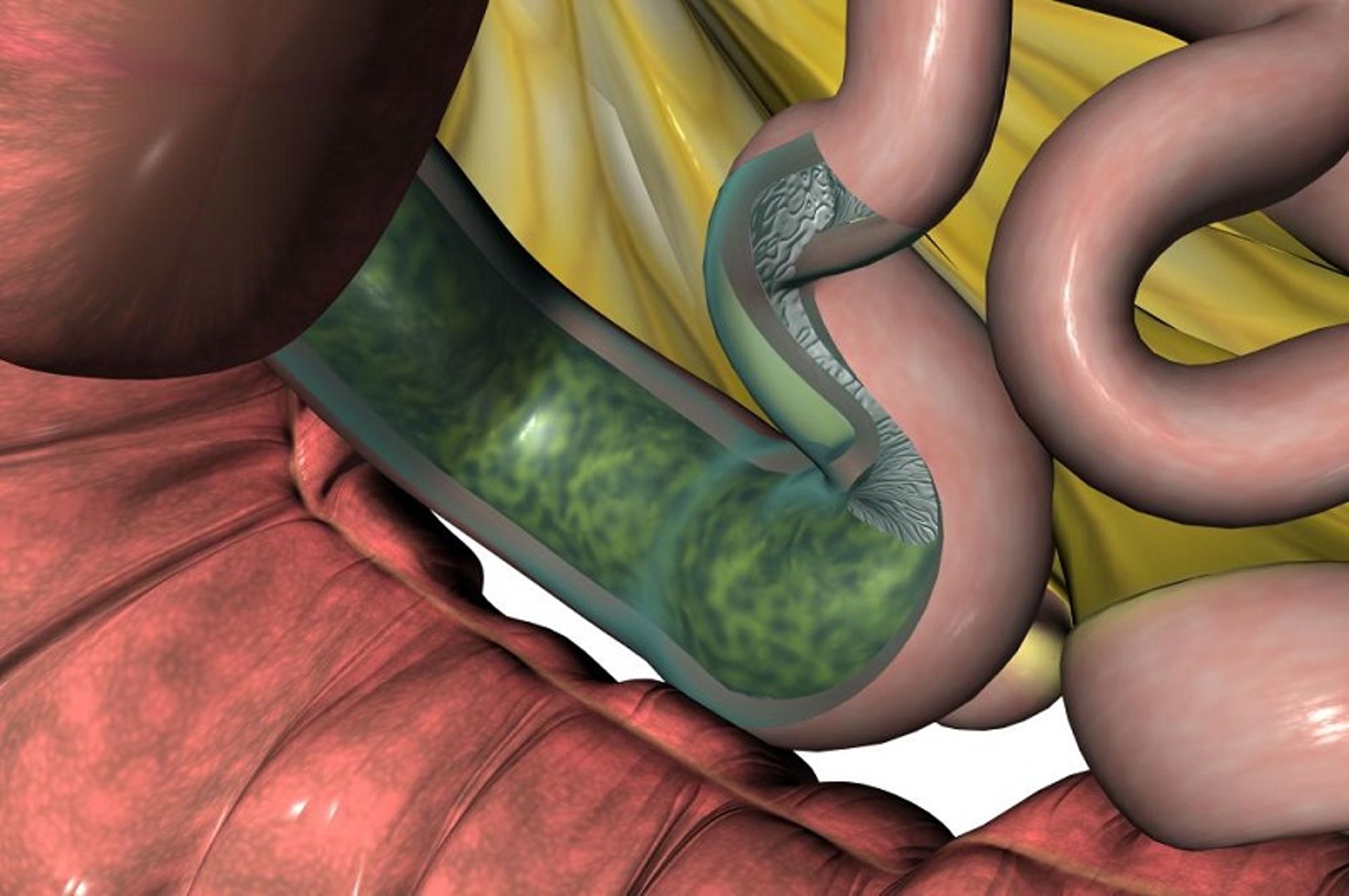 Ileal impaction, horse