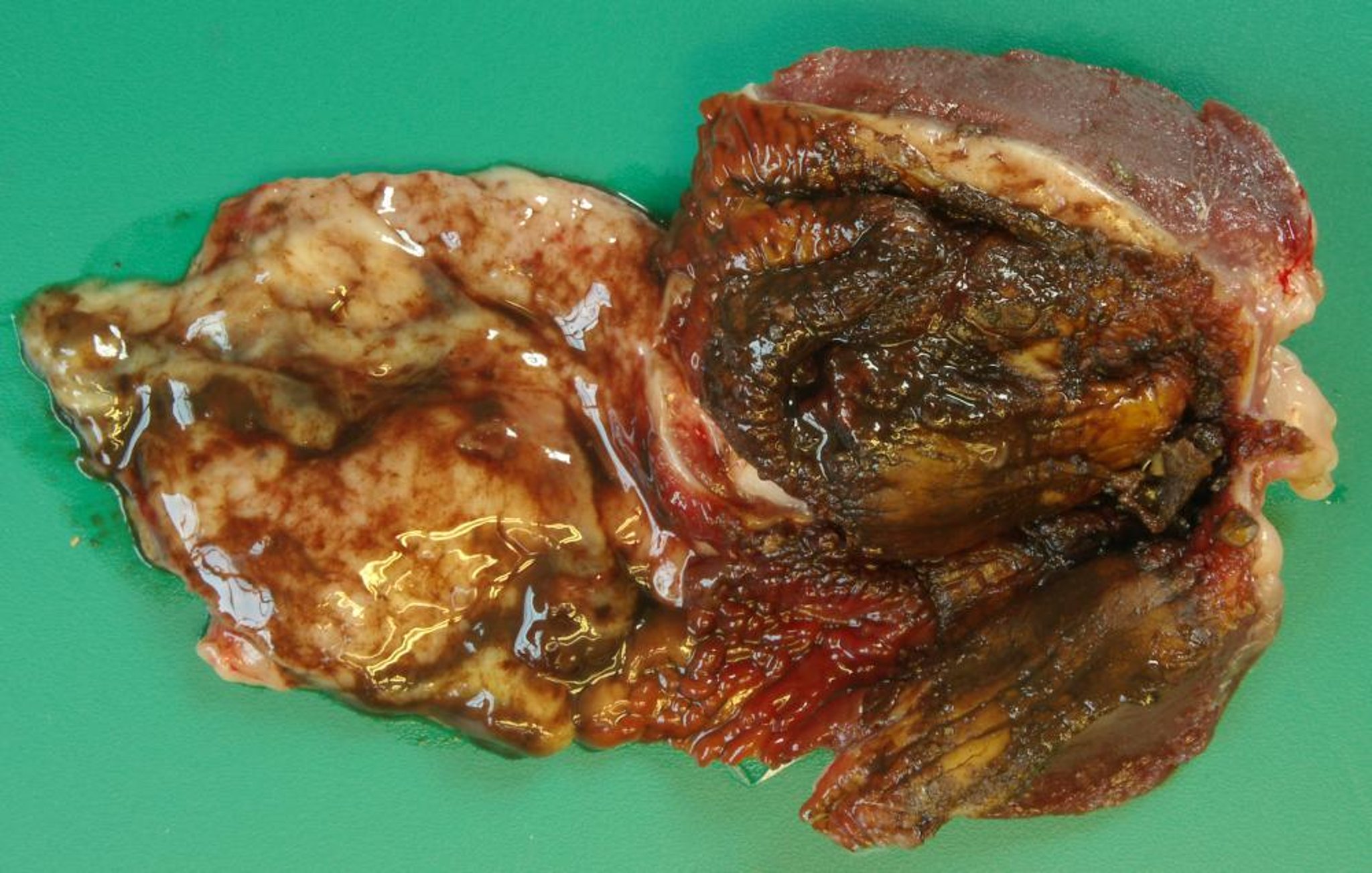 Duck viral enteritis, inflammation of proventriculus and gizzard