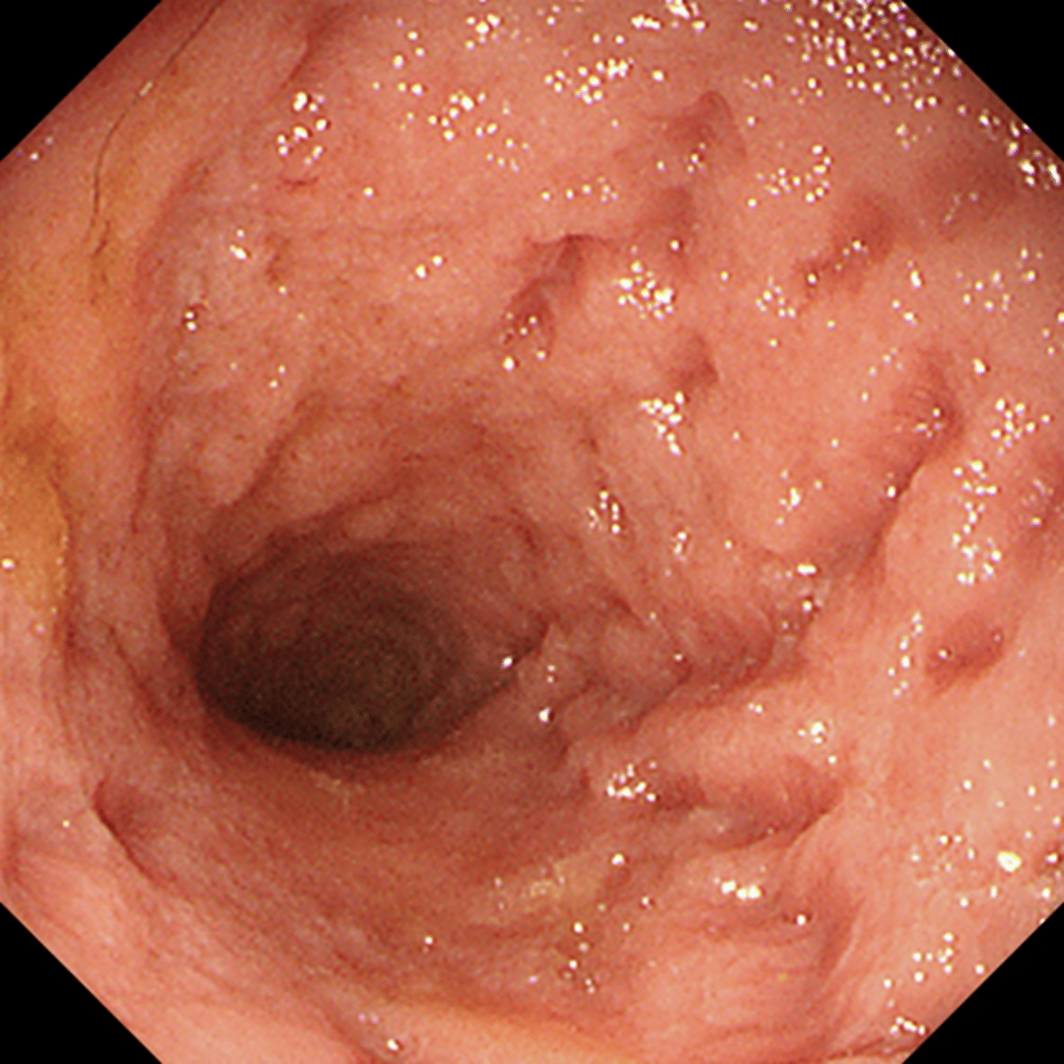 Enteritis linfoplasmocitaria, malabsorción, perro