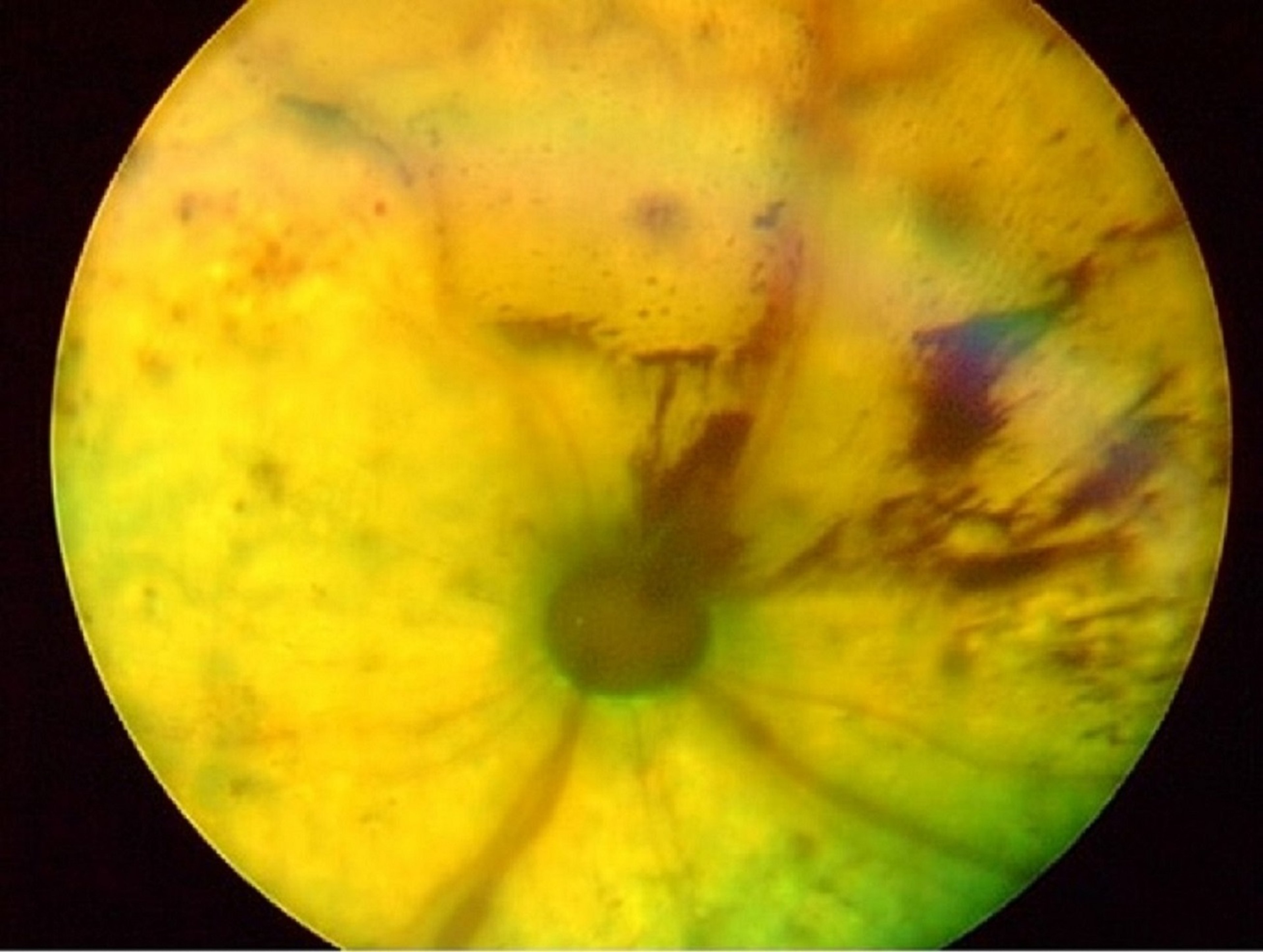 Intraocular hemorrhage and retinal detachment secondary to systemic hypertension, cat