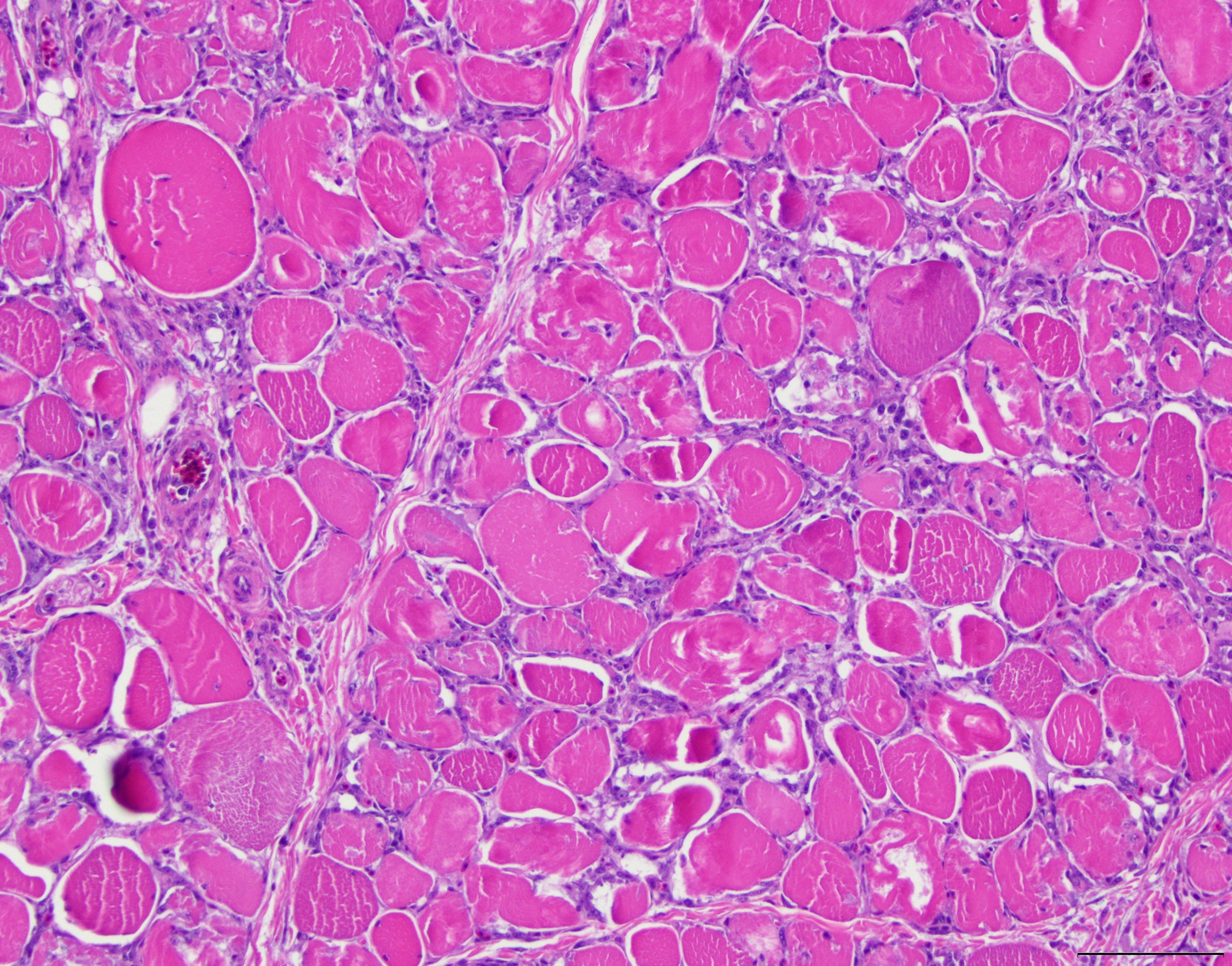 Ionophore toxicosis, skeletal muscle, turkey