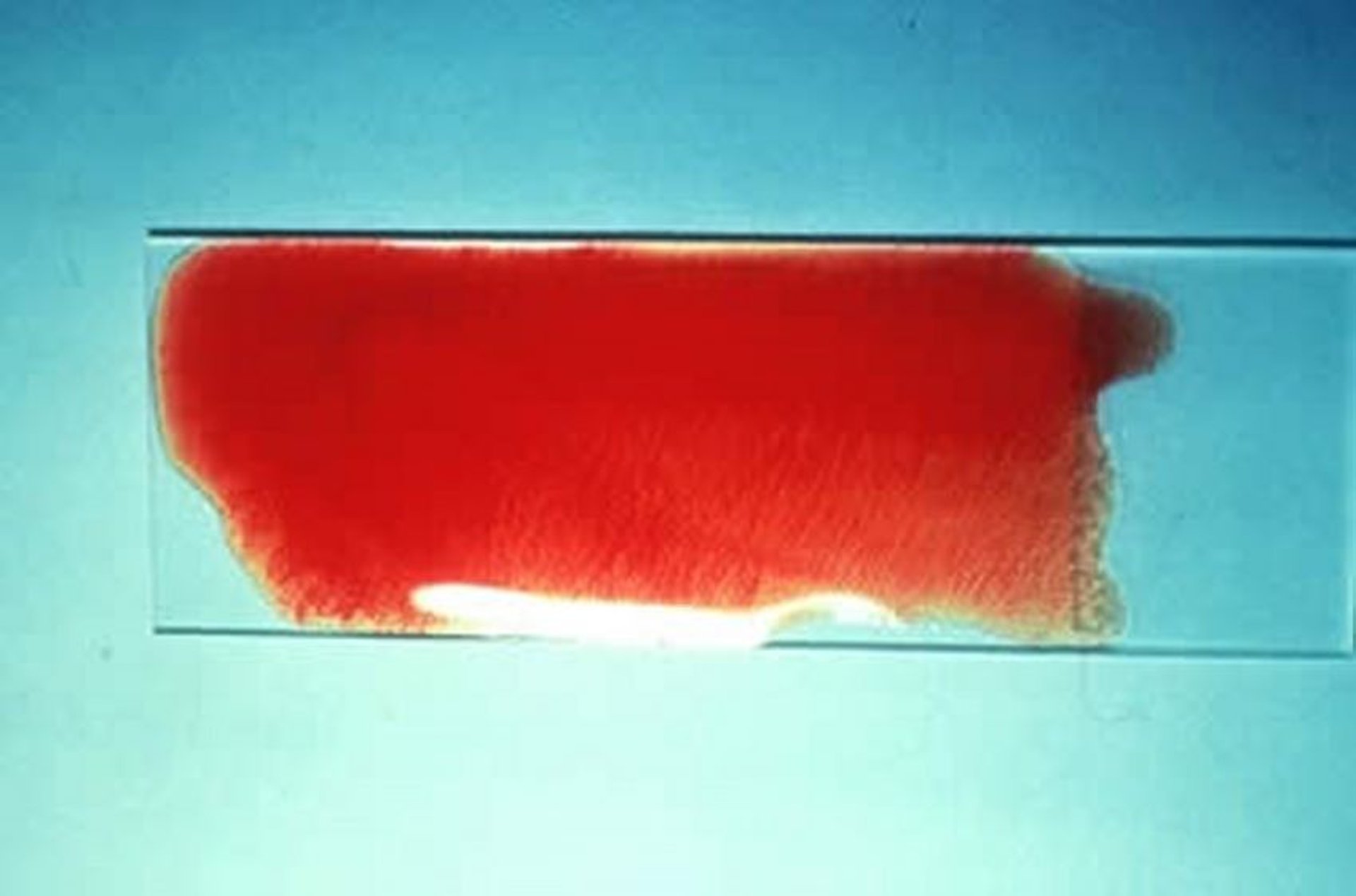 Anemia hemolítica de origen inmunitario, aglutinación