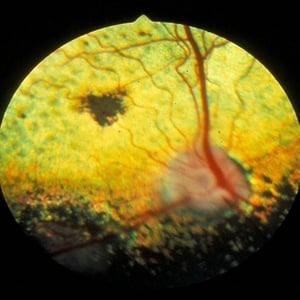 Coriorretinitis inactiva secundaria a blastomicosis sistémica, perro