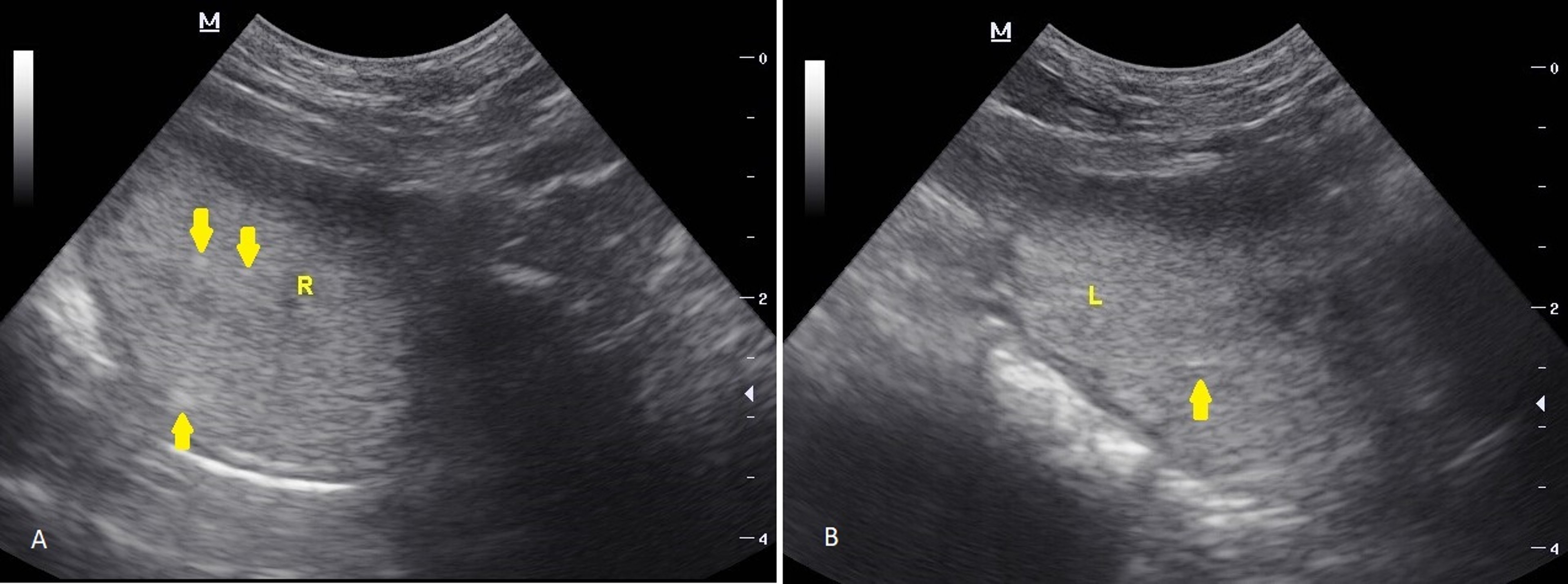 Inflamación, próstata, ecografía transabdominal