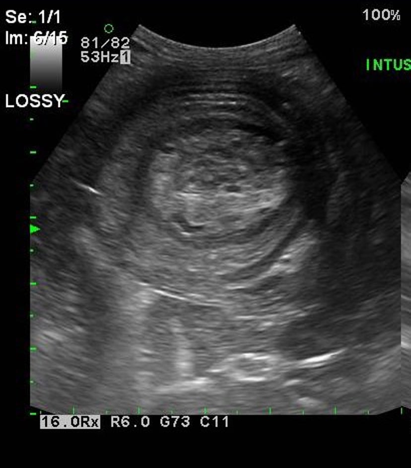 Intususcepción intestinal, ecografía, perro