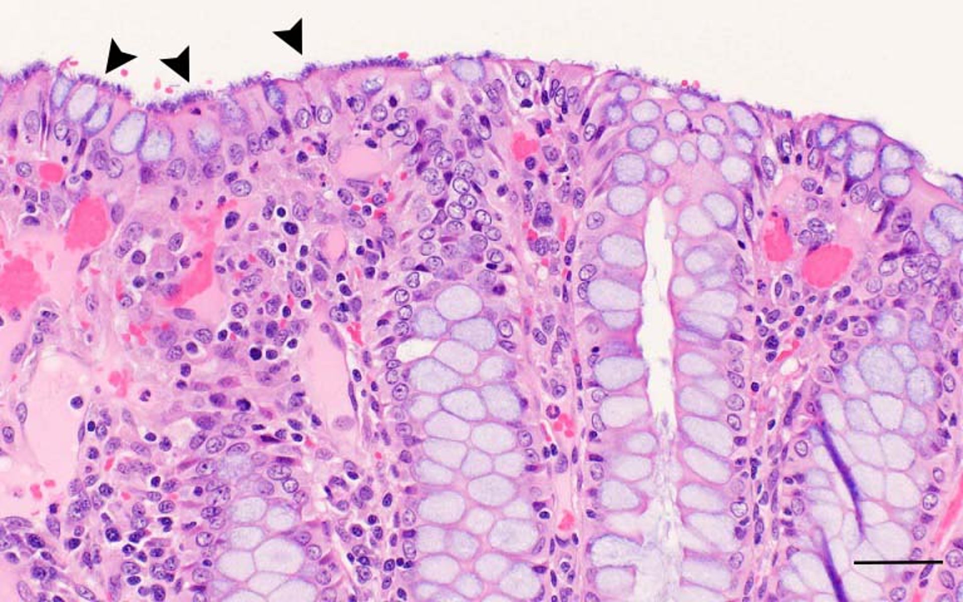 Espiroquetosis intestinal, histopatología, porcino