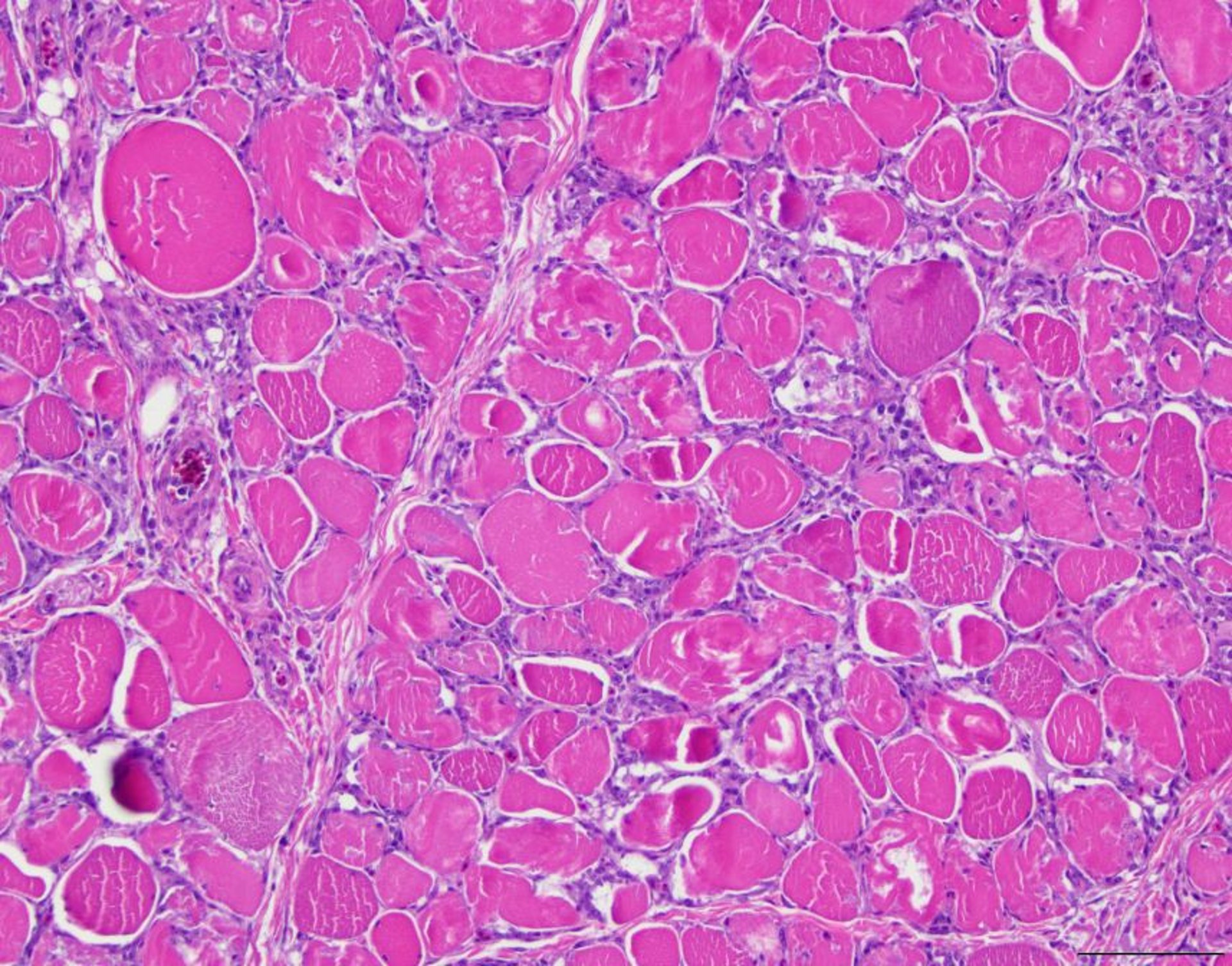 Ionophore toxicosis, skeletal muscle, turkey