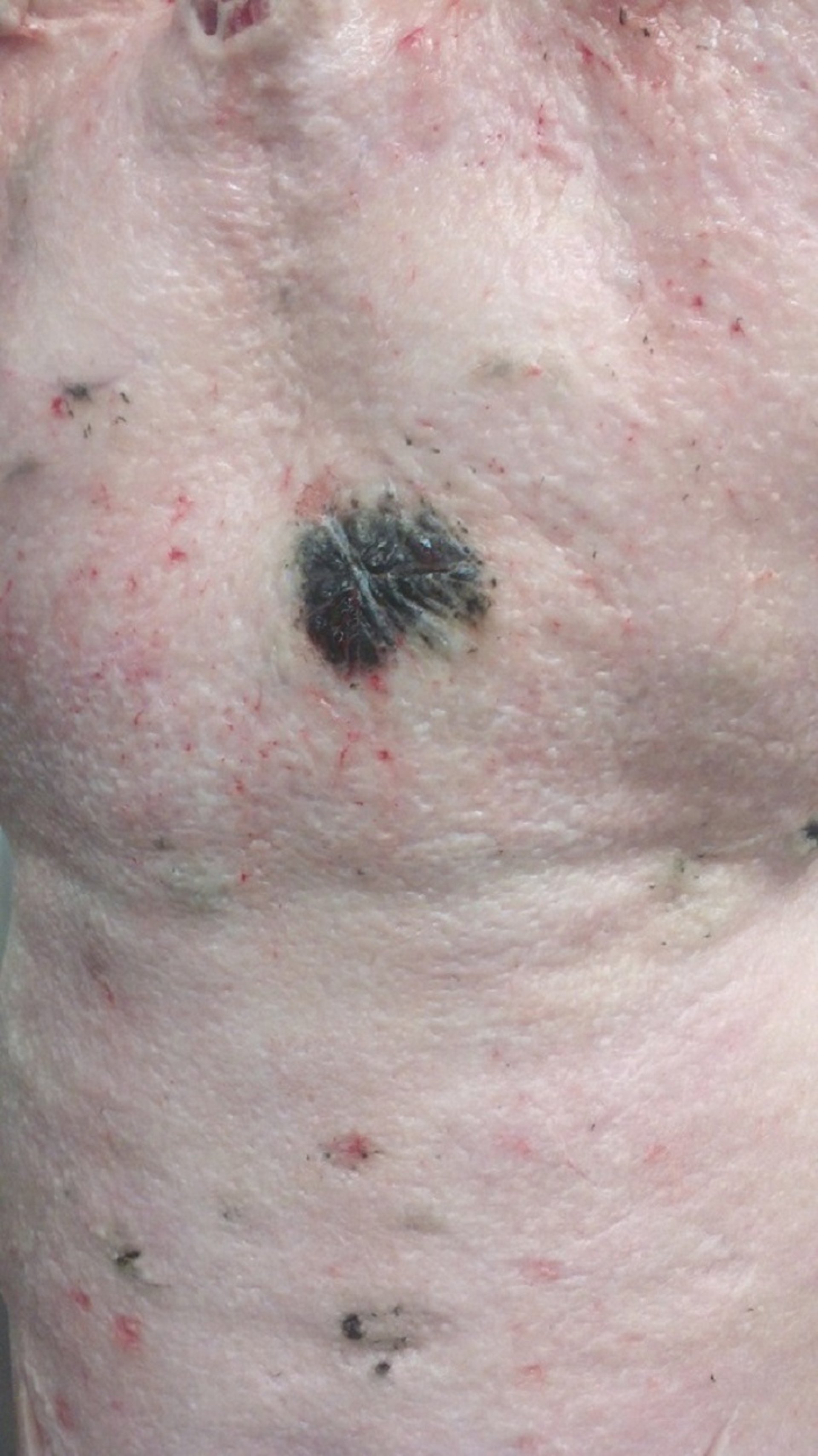 Melanoma aislado, cerdo comercial