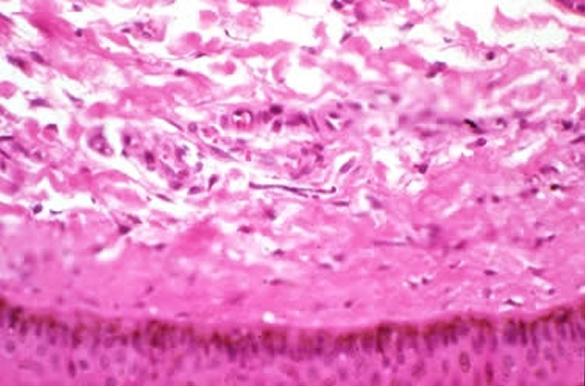 Dermatitis asociada a <i >Onchocerca</i>, histopatología, caballo