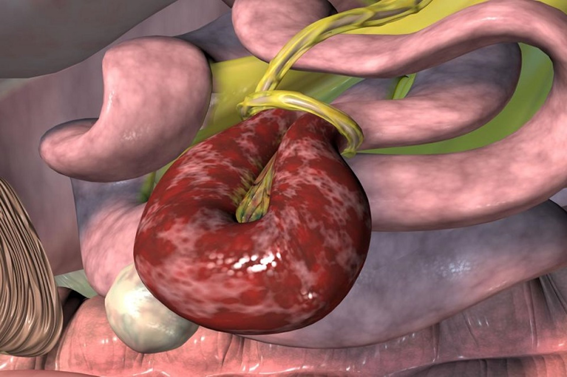 Jejunum strangulation by lipoma, horse