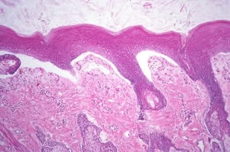 Junctional epidermolysis bullosa (histopathology), horse