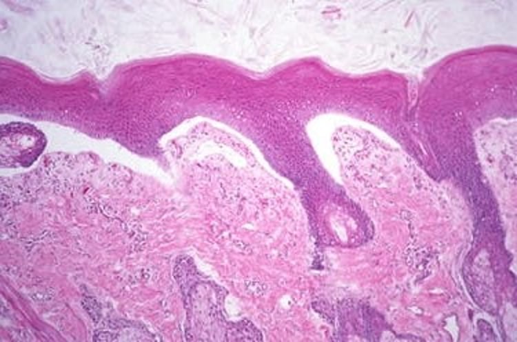 Epidermólisis ampollosa juntural (histopatología), caballo