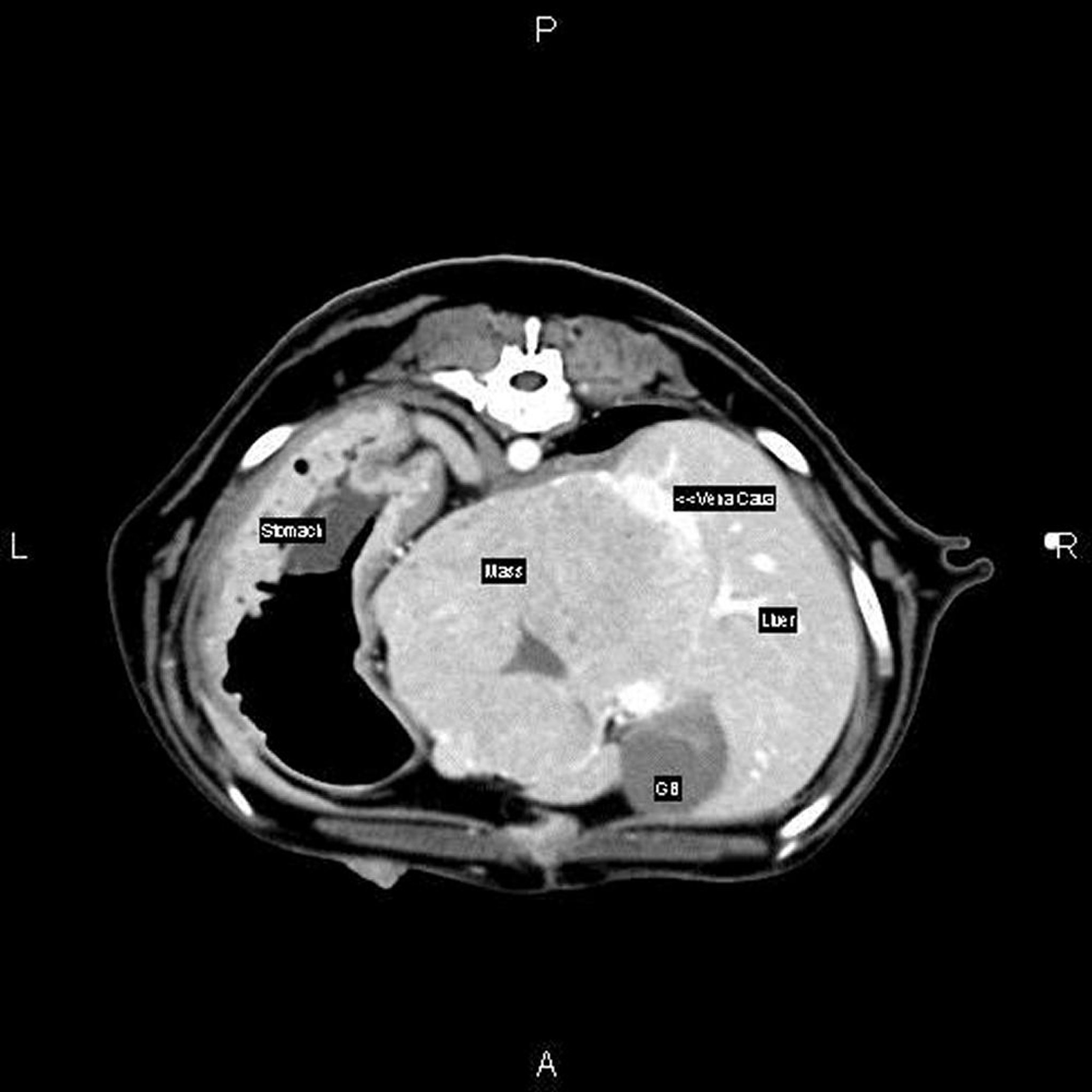 Large liver mass, CT