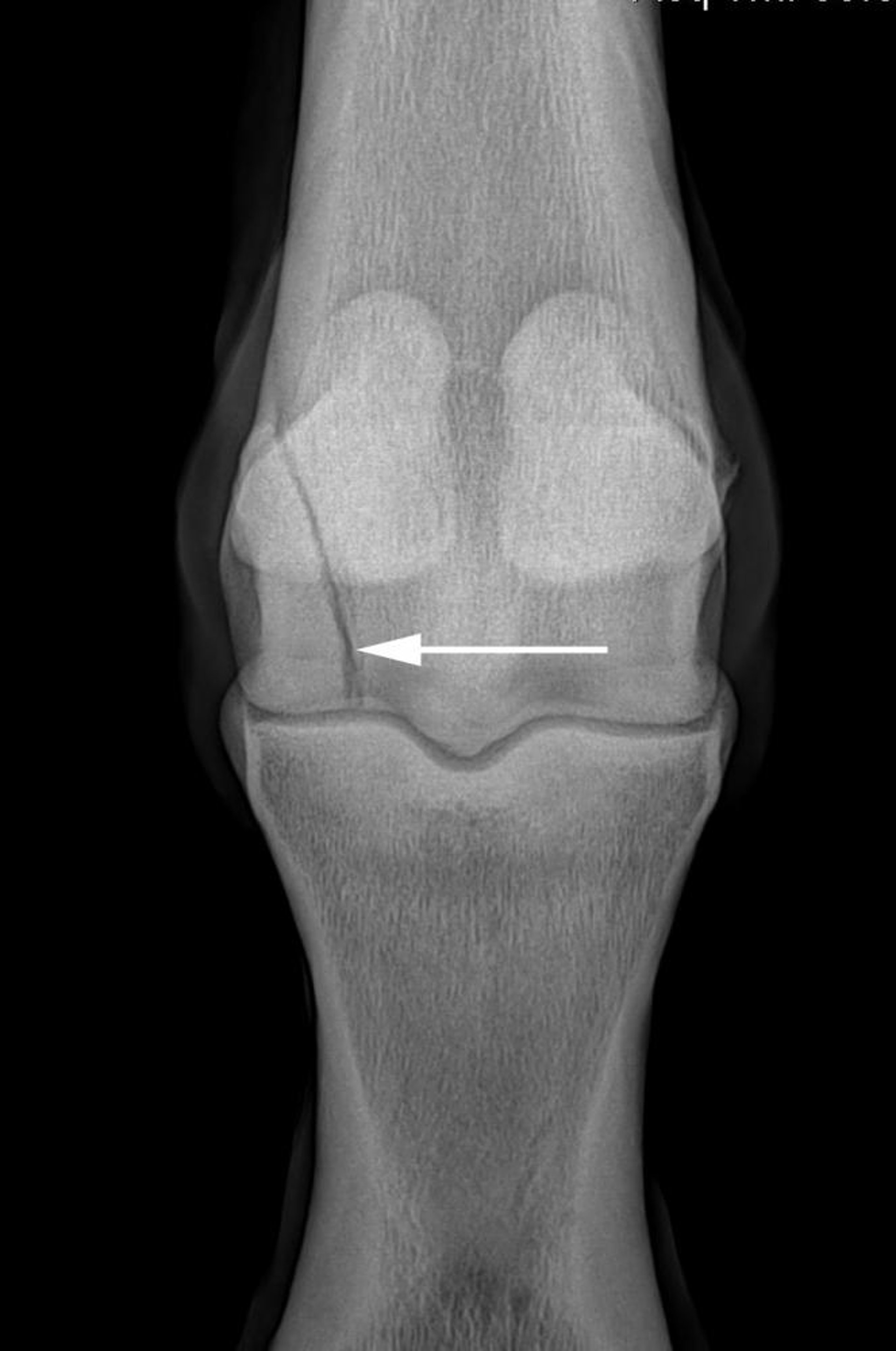 Lateral condylar fracture of the distal third metacarpal bone, radiograph, horse