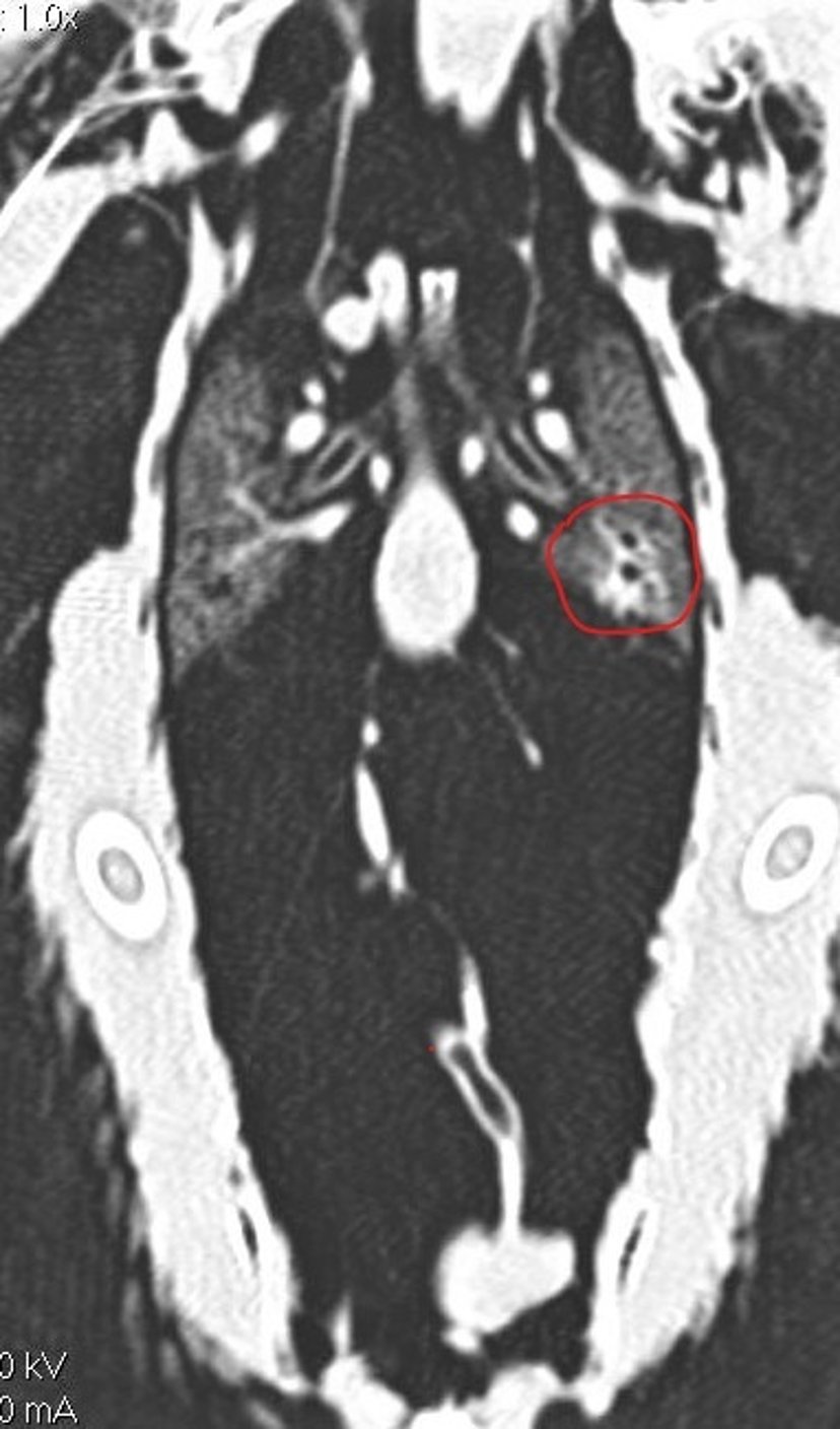 Lesion, CT scan