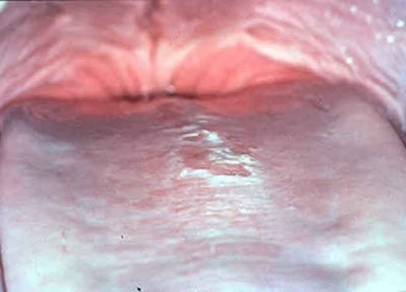 Lingual candidiasis, dolphin