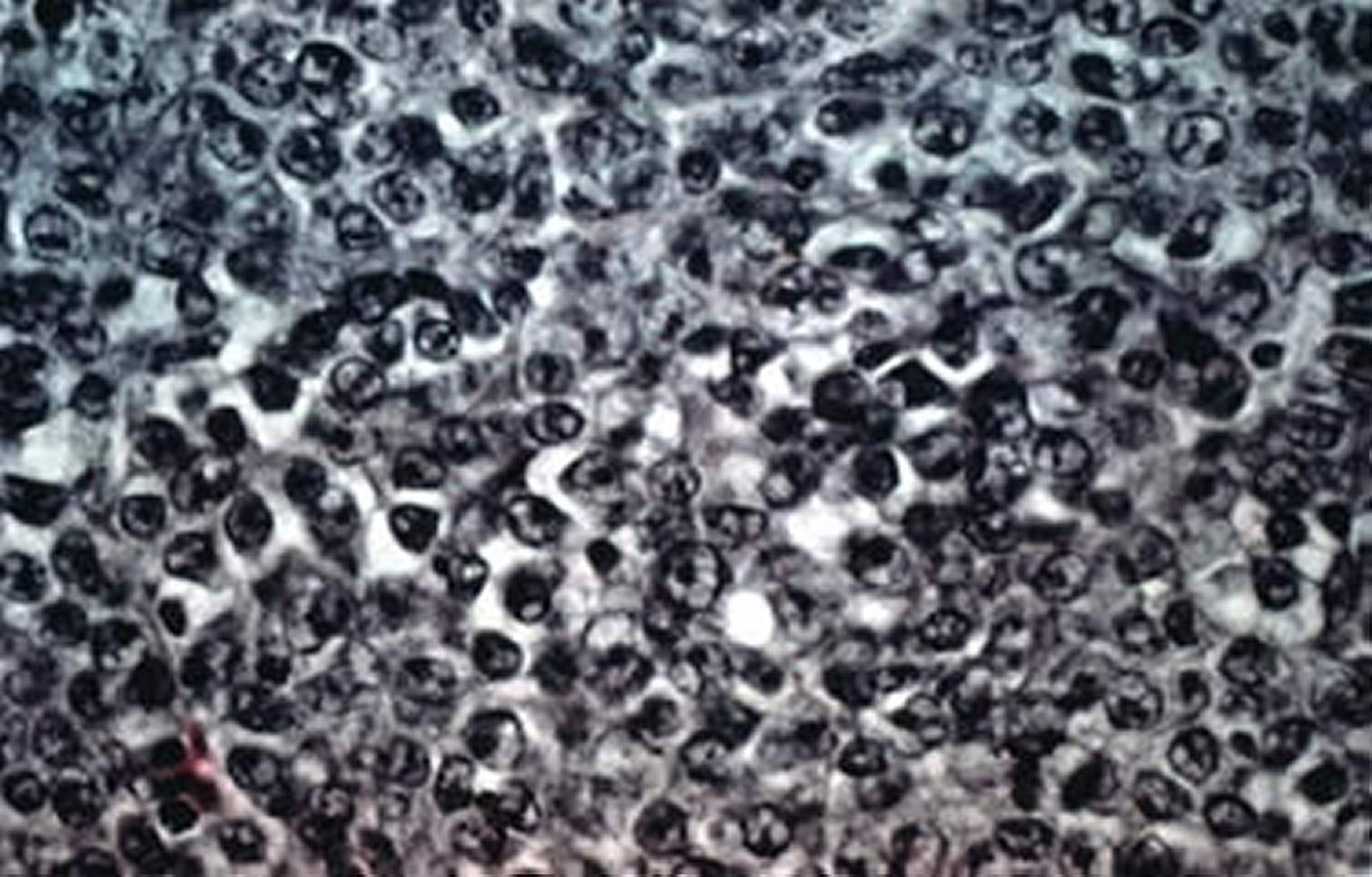 Lymphoid leukosis, lymphocytic infiltration, liver, chicken