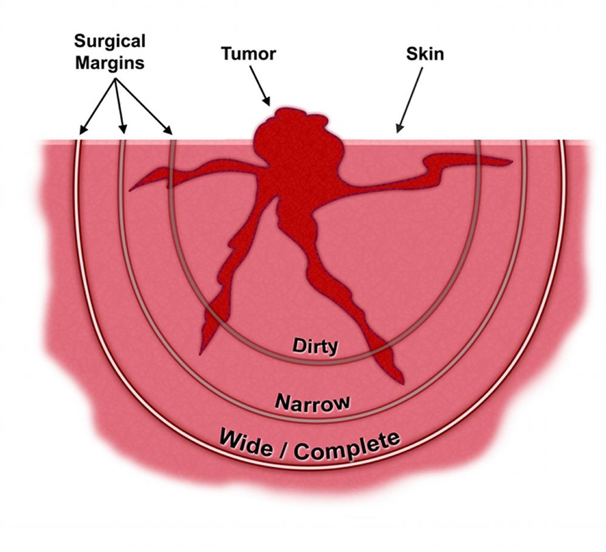 Malignant tumor tentacles and surgical margins