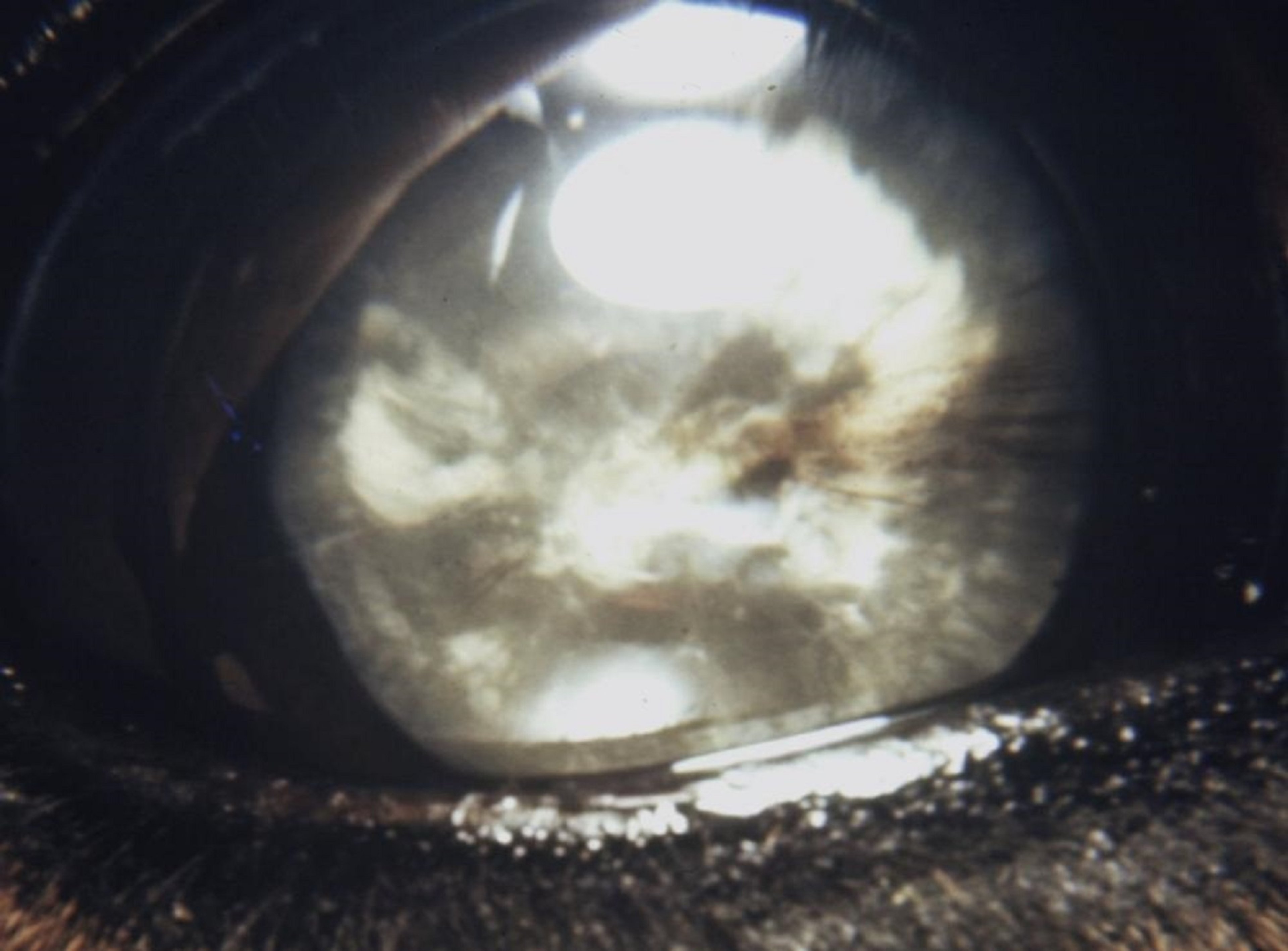 Mature cataract secondary to anterior uveitis, adult horse