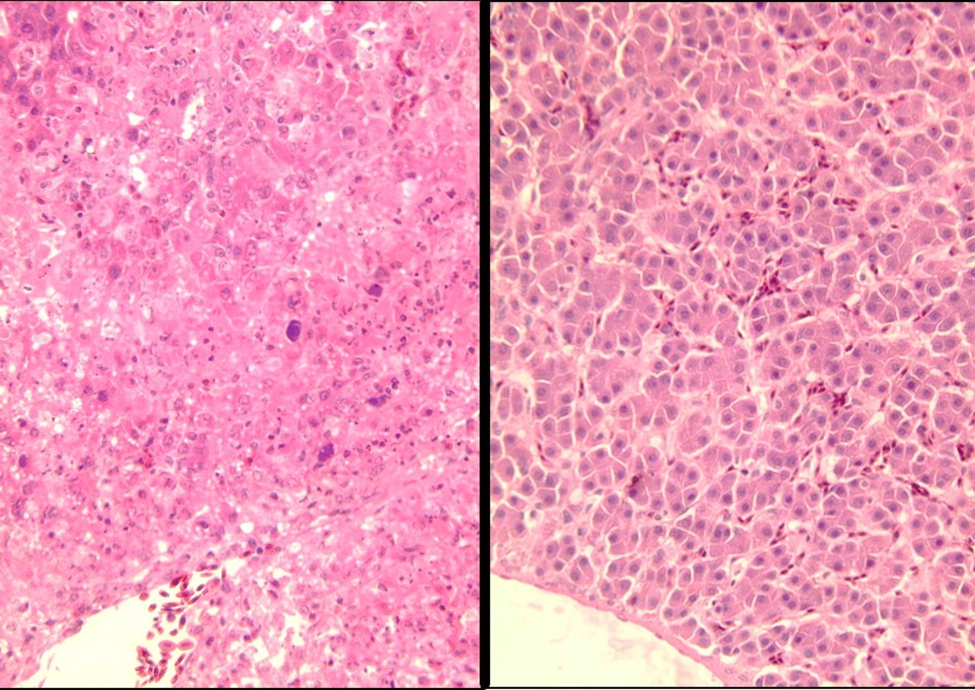 Microscopic hepatic lesions, IBH and HHS