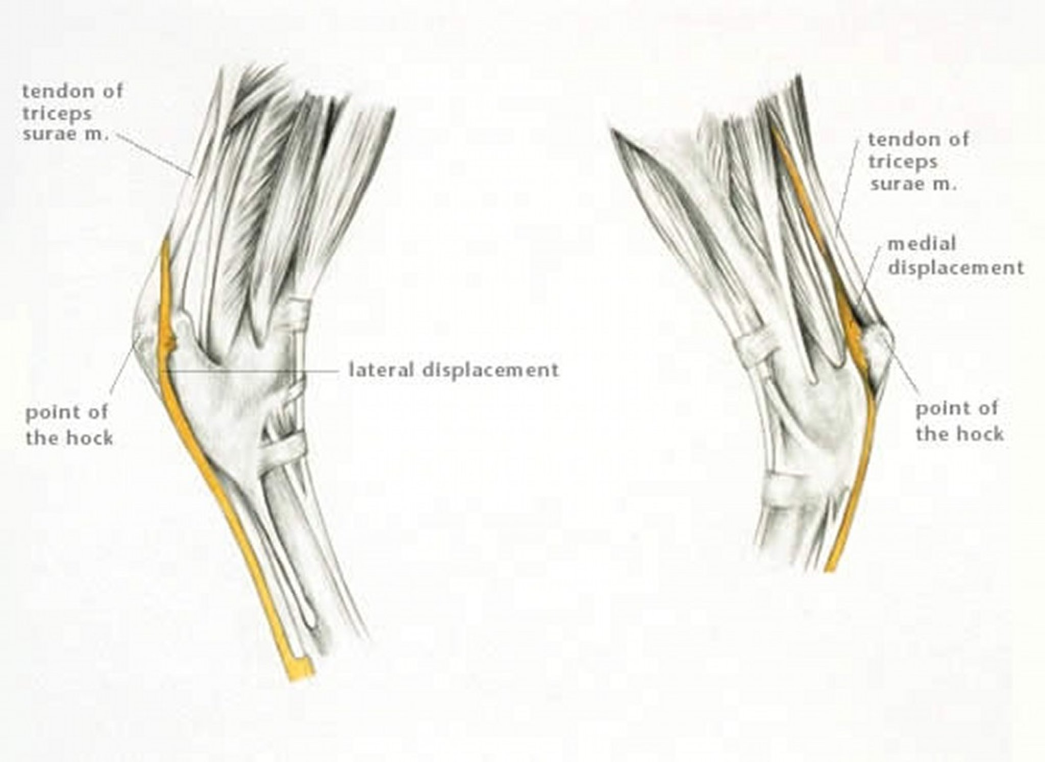 Displacement of superficial digital flexor tendon, horse