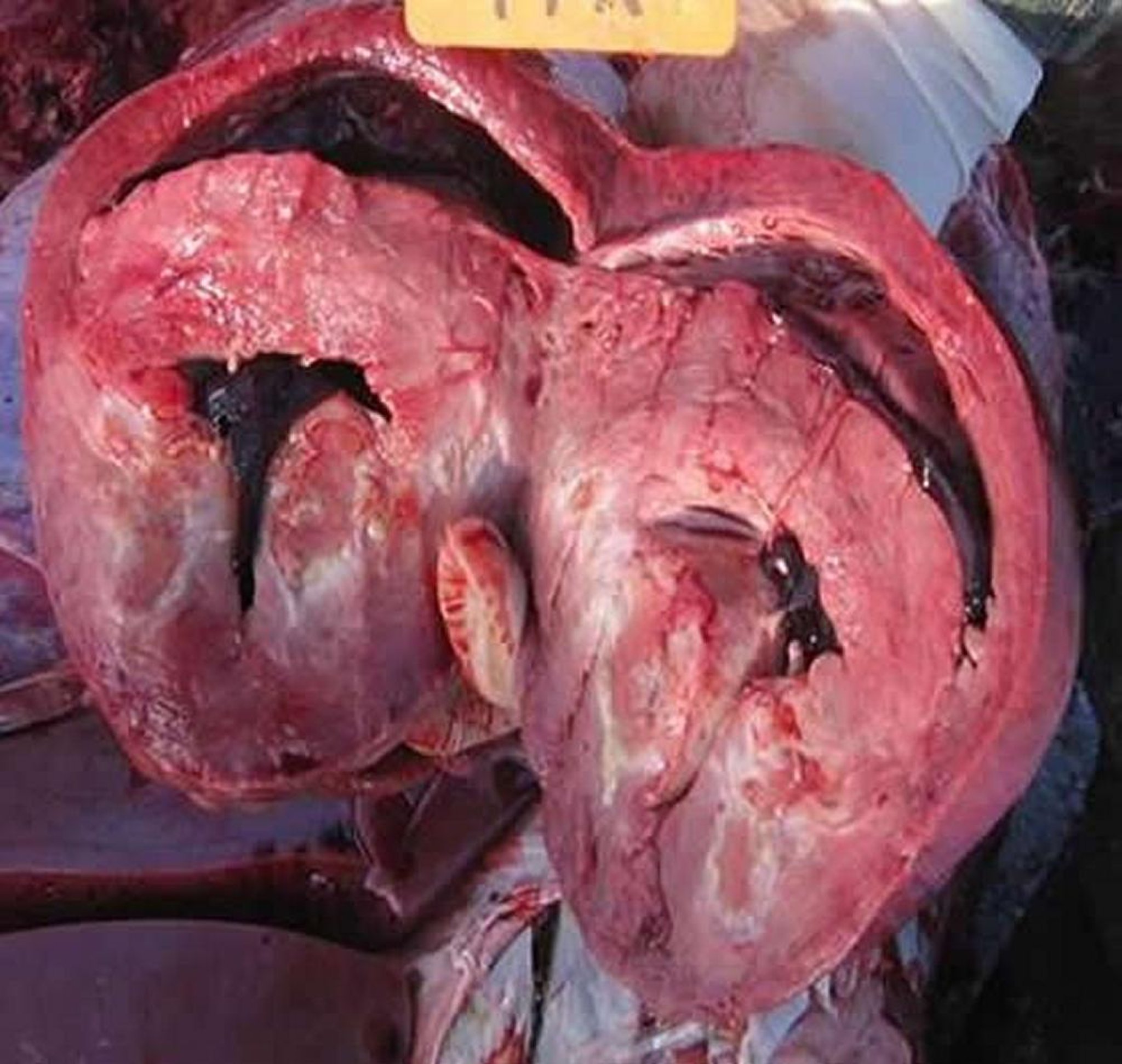Myocardial necrotic sequestrum