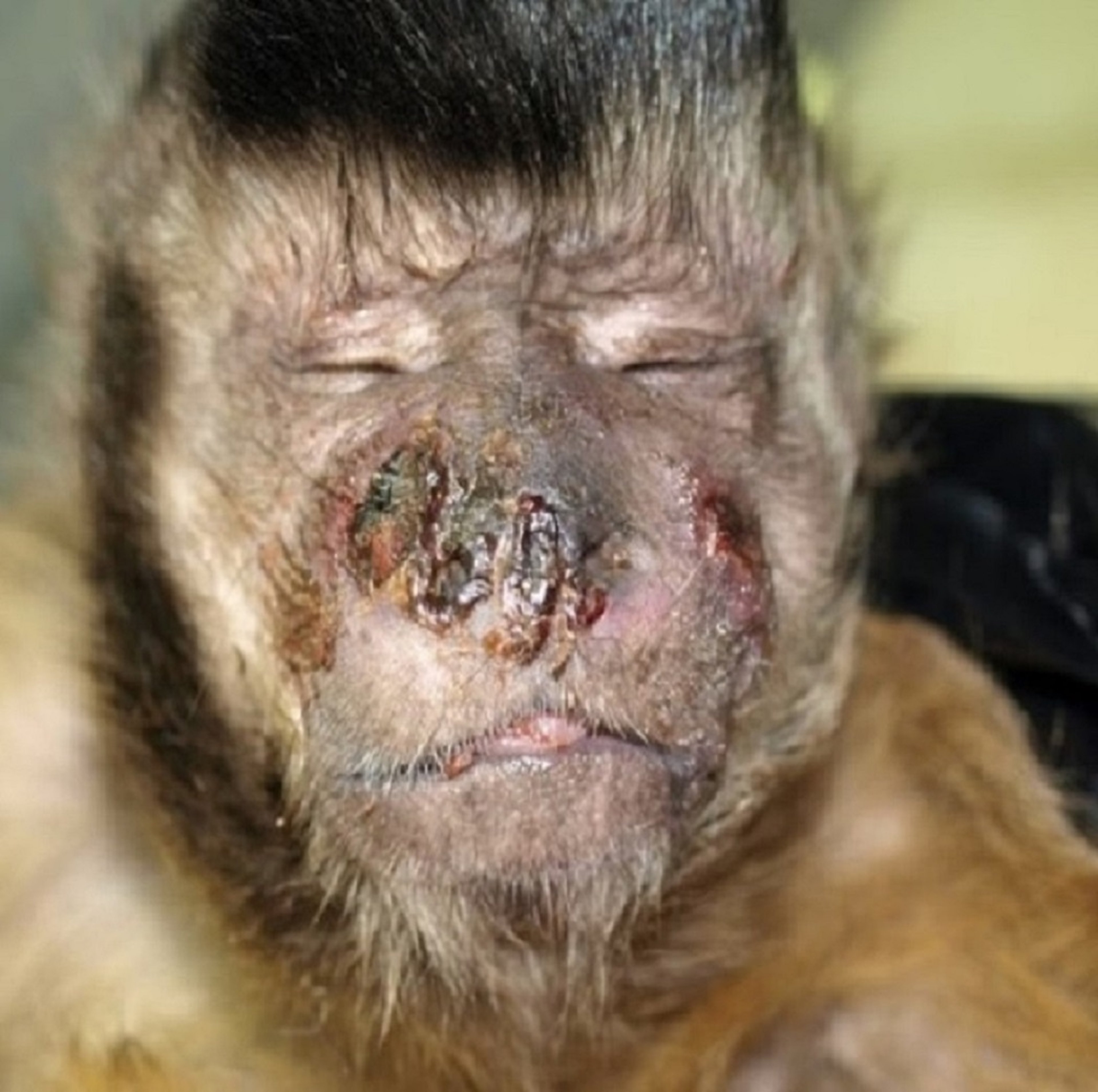 Melioidosis, mono