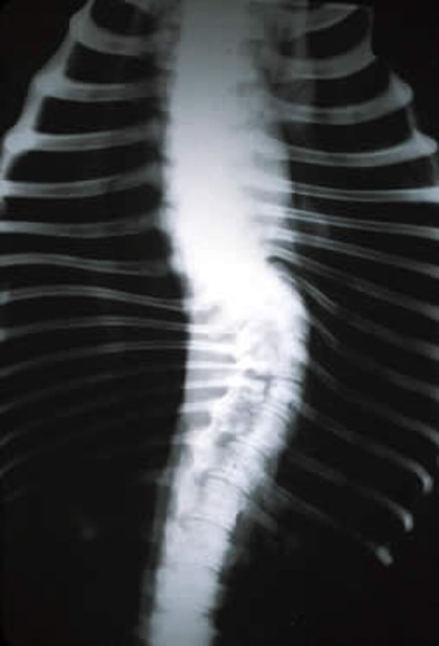Lordosis equina, radiografía