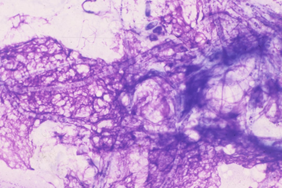 Queratitis micótica, <i >Aspergillus</i>