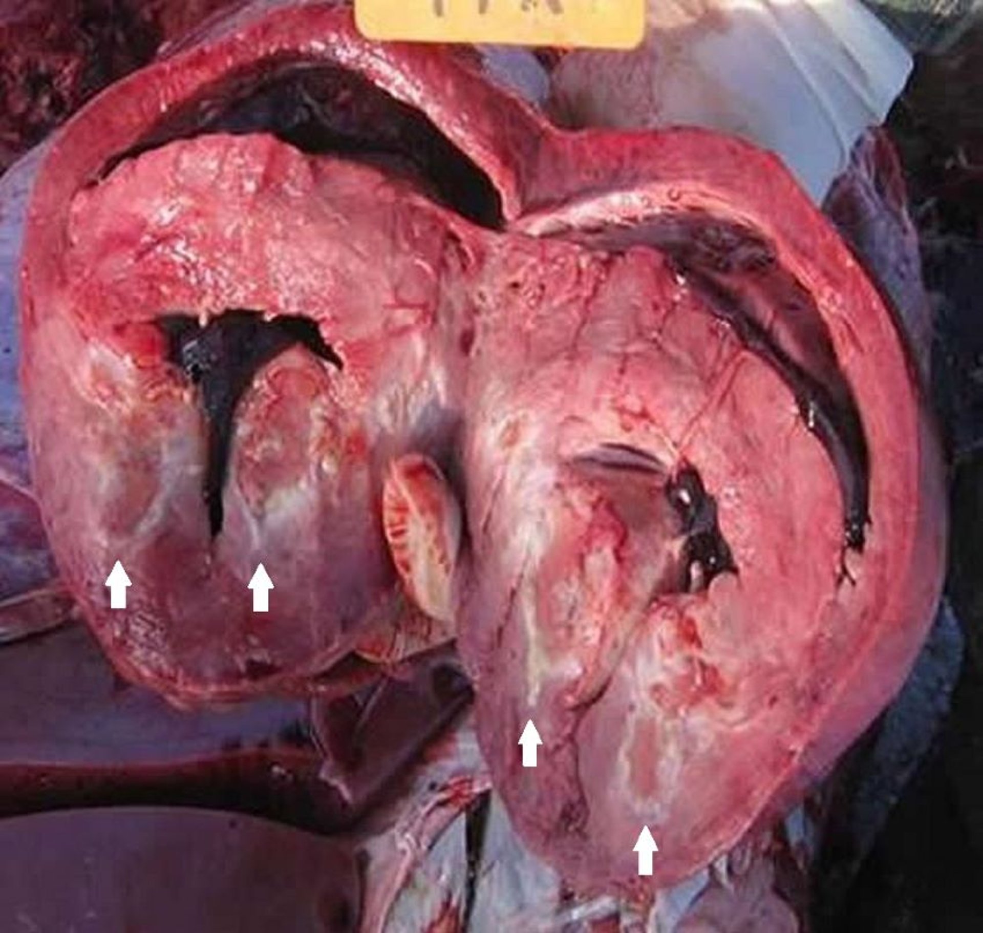 Myocardial necrotic sequestrum, cow