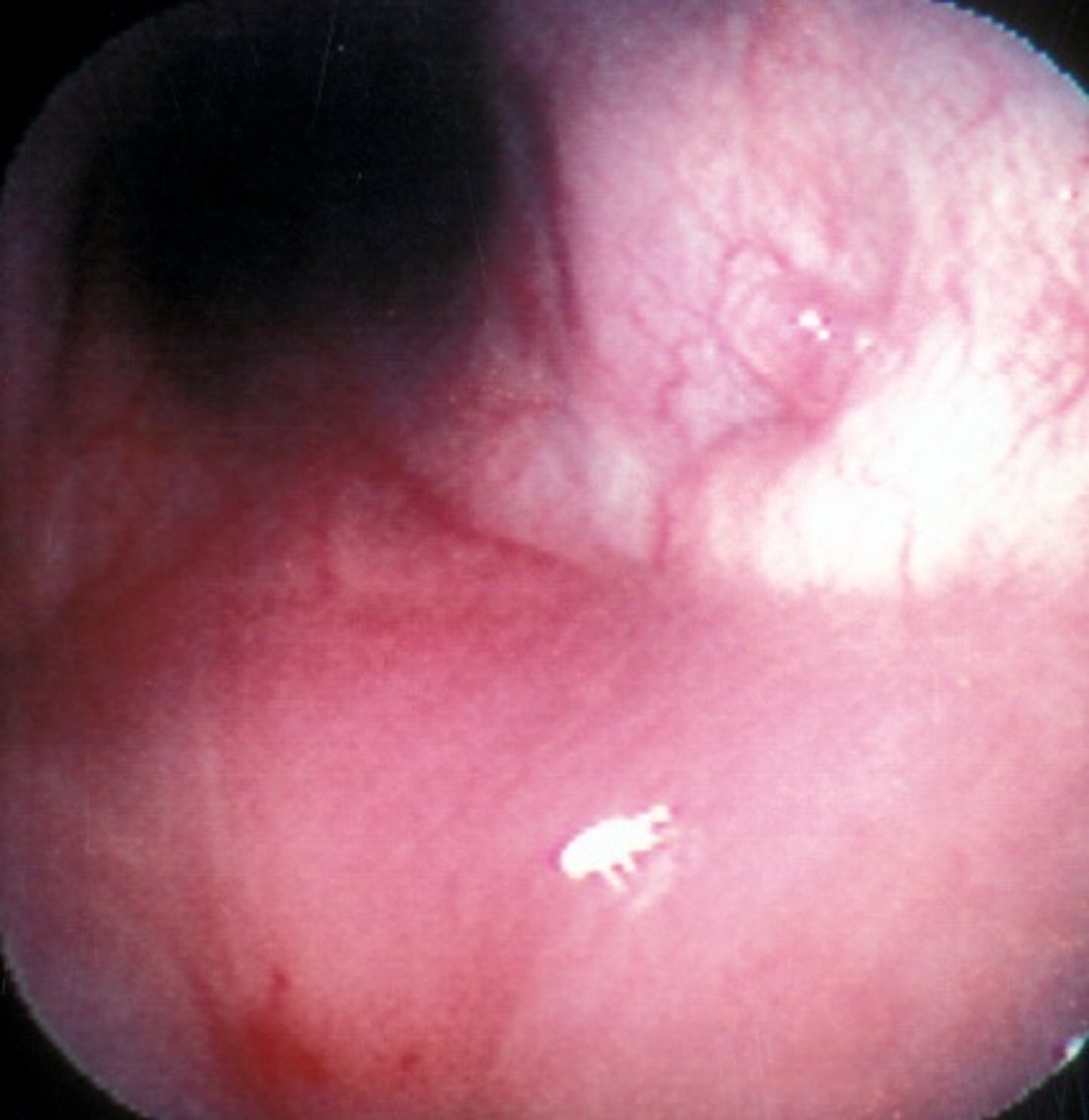 Nasal mite (endoscopic view)