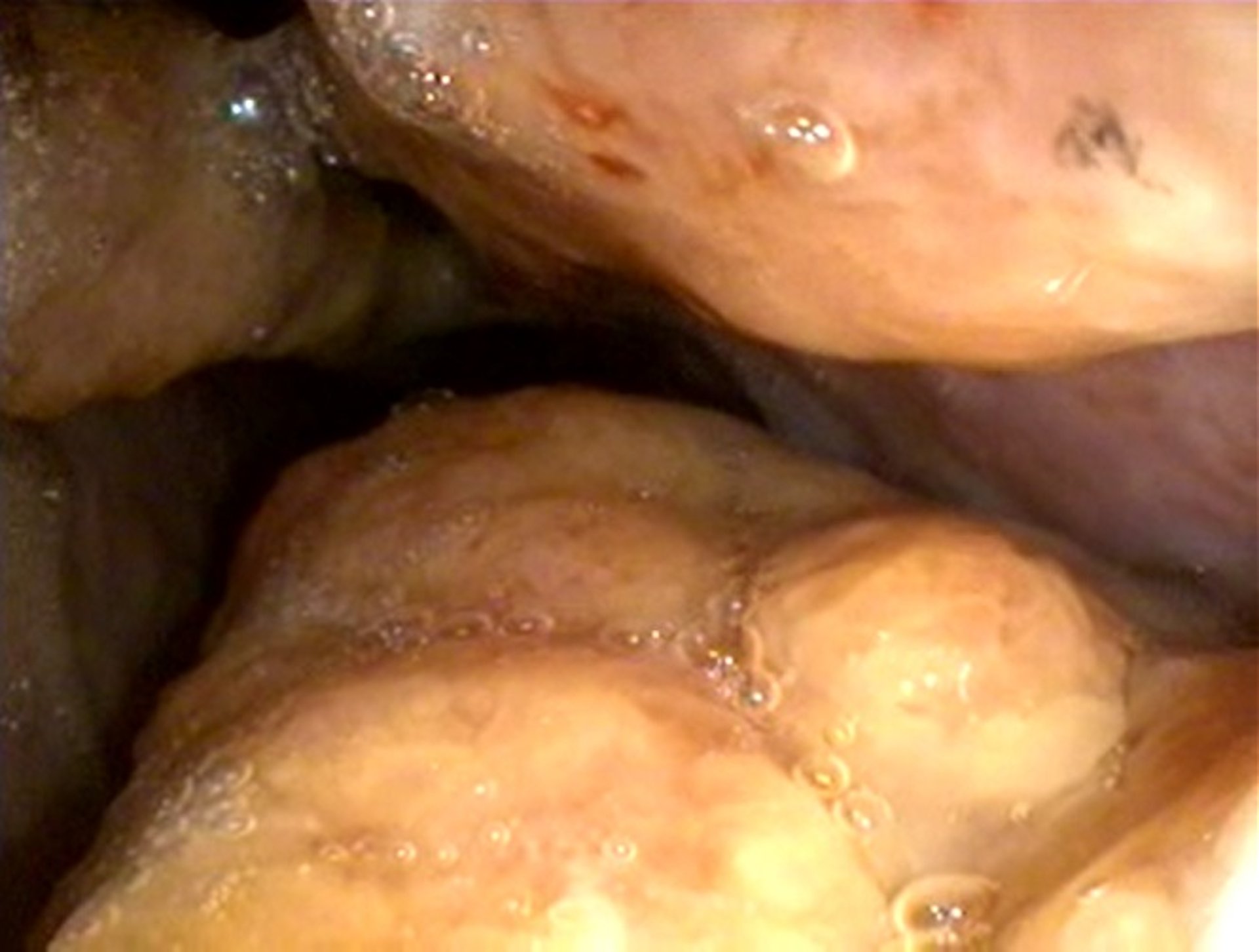 Rhinoscopic view, nasal cavity