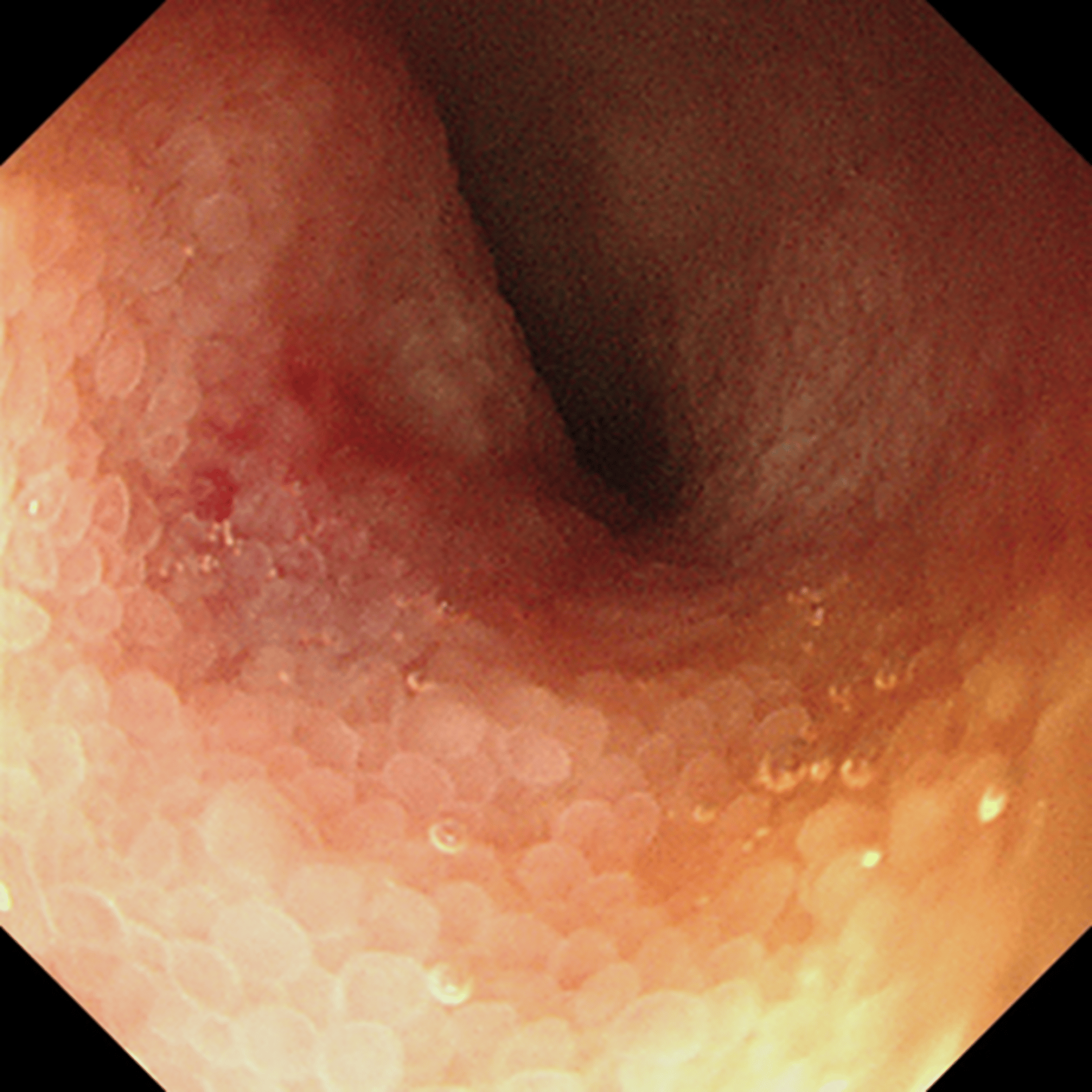 Small intestine