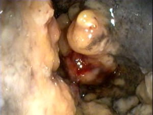 Granuloma nasal