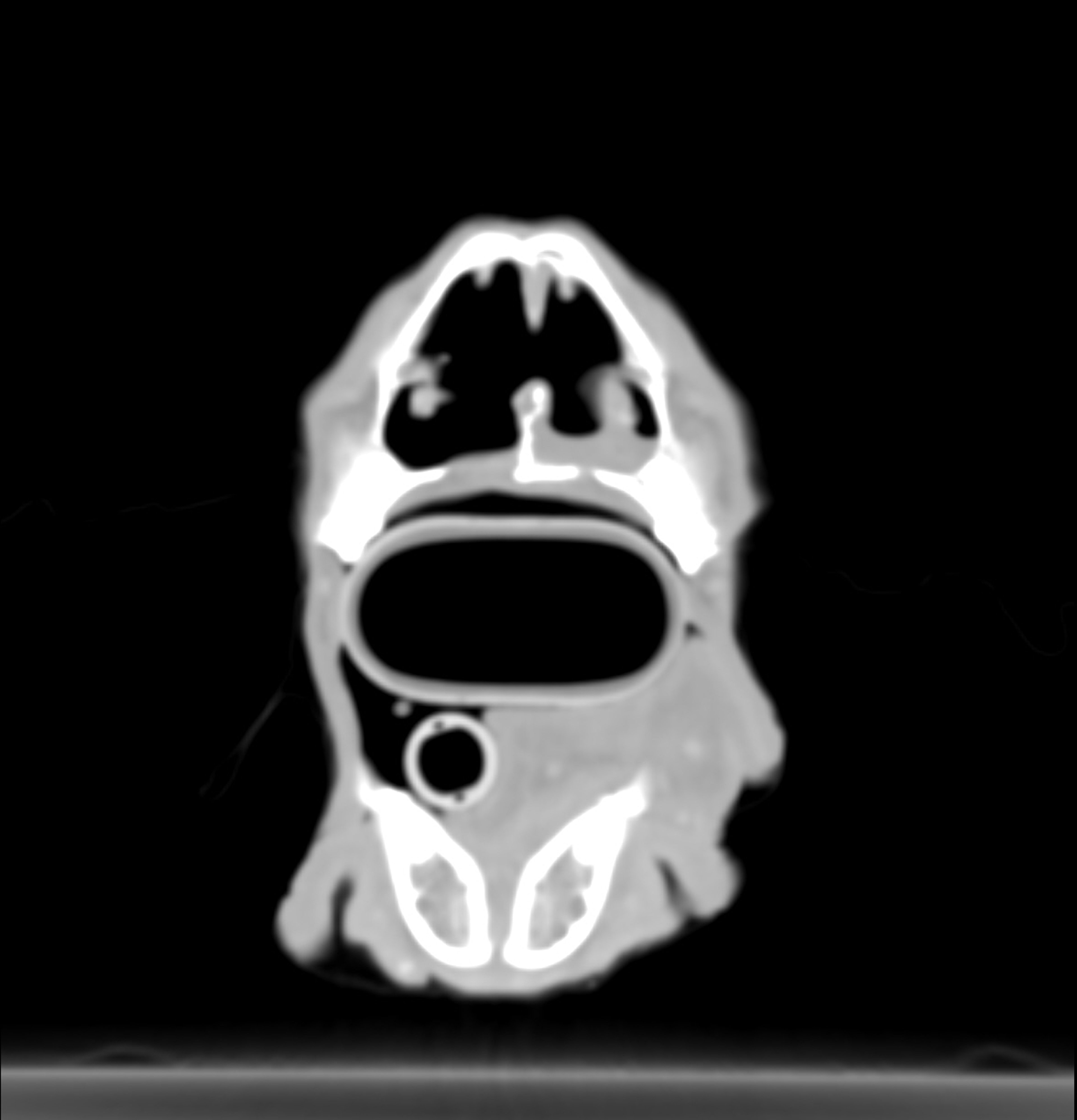 Tumor nasal después del tratamiento, TC