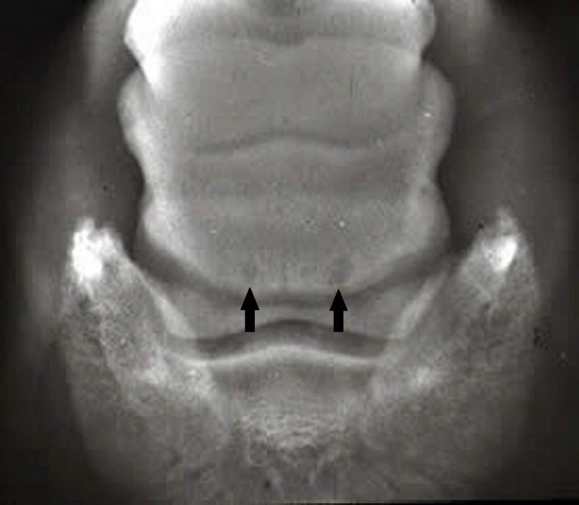Navicular syndrome, enlarged vascular channels, radiograph, horse
