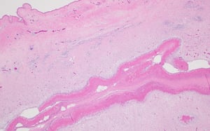 Necrotic dermatitis, photomicrograph, poultry