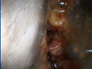 Cavidad nasal obstruida