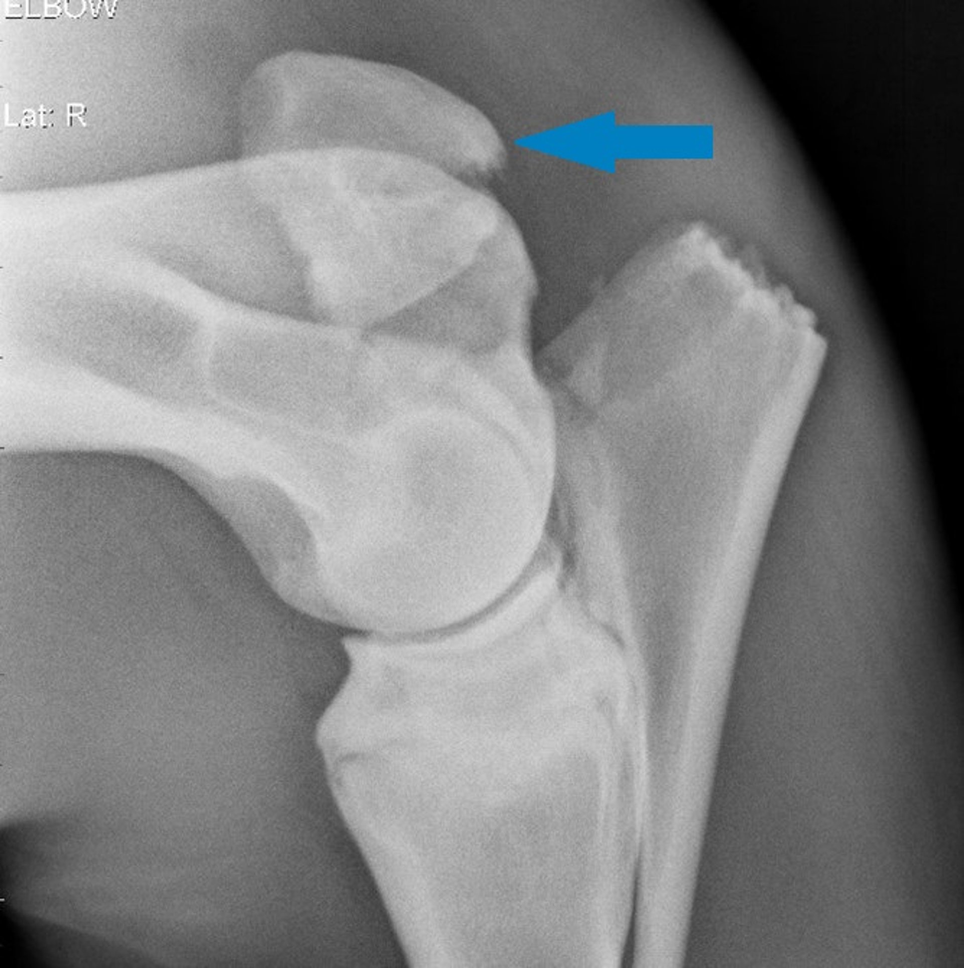 Olecranon fracture, radiograph, horse