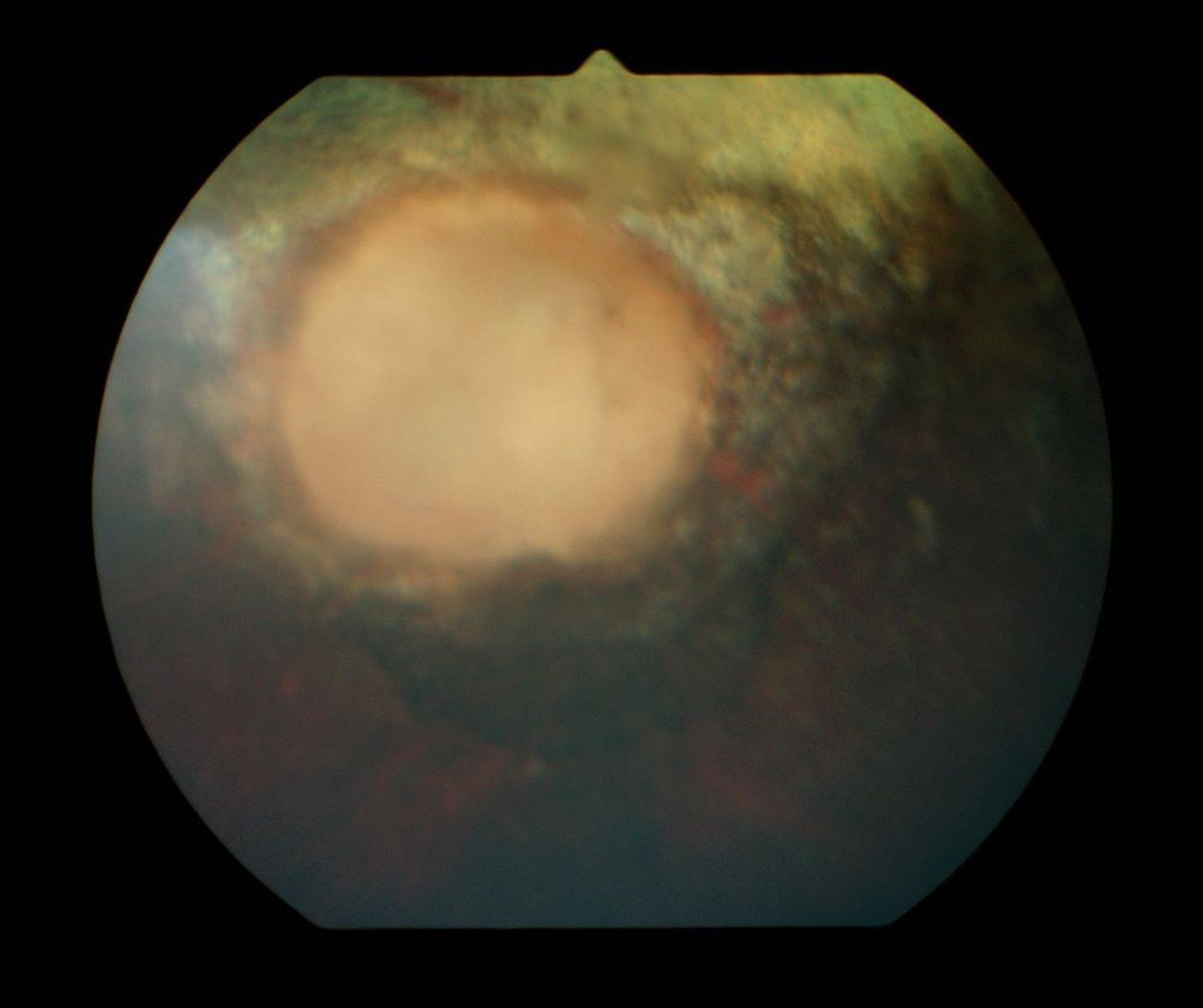 Optic nerve atrophy and peripapillary retinal degeneration, horse